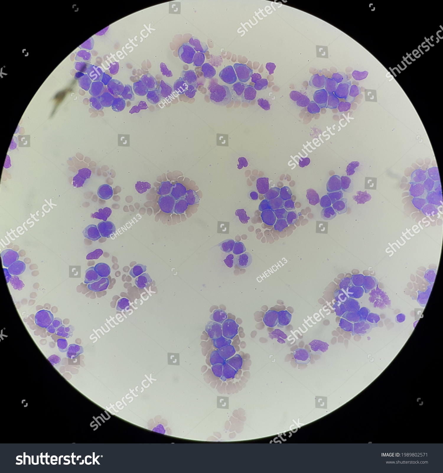 Blast Cells Blood Smear Stock Photo 1989802571 | Shutterstock