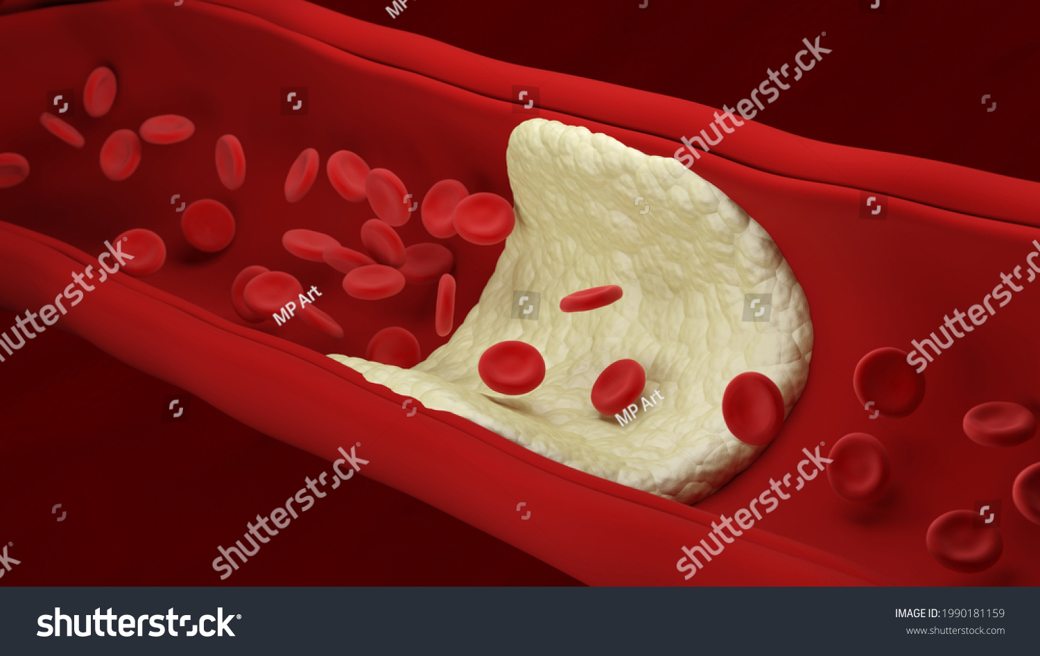 Atherosclerosis Red Blood Cells Artery Build Stock Illustration ...