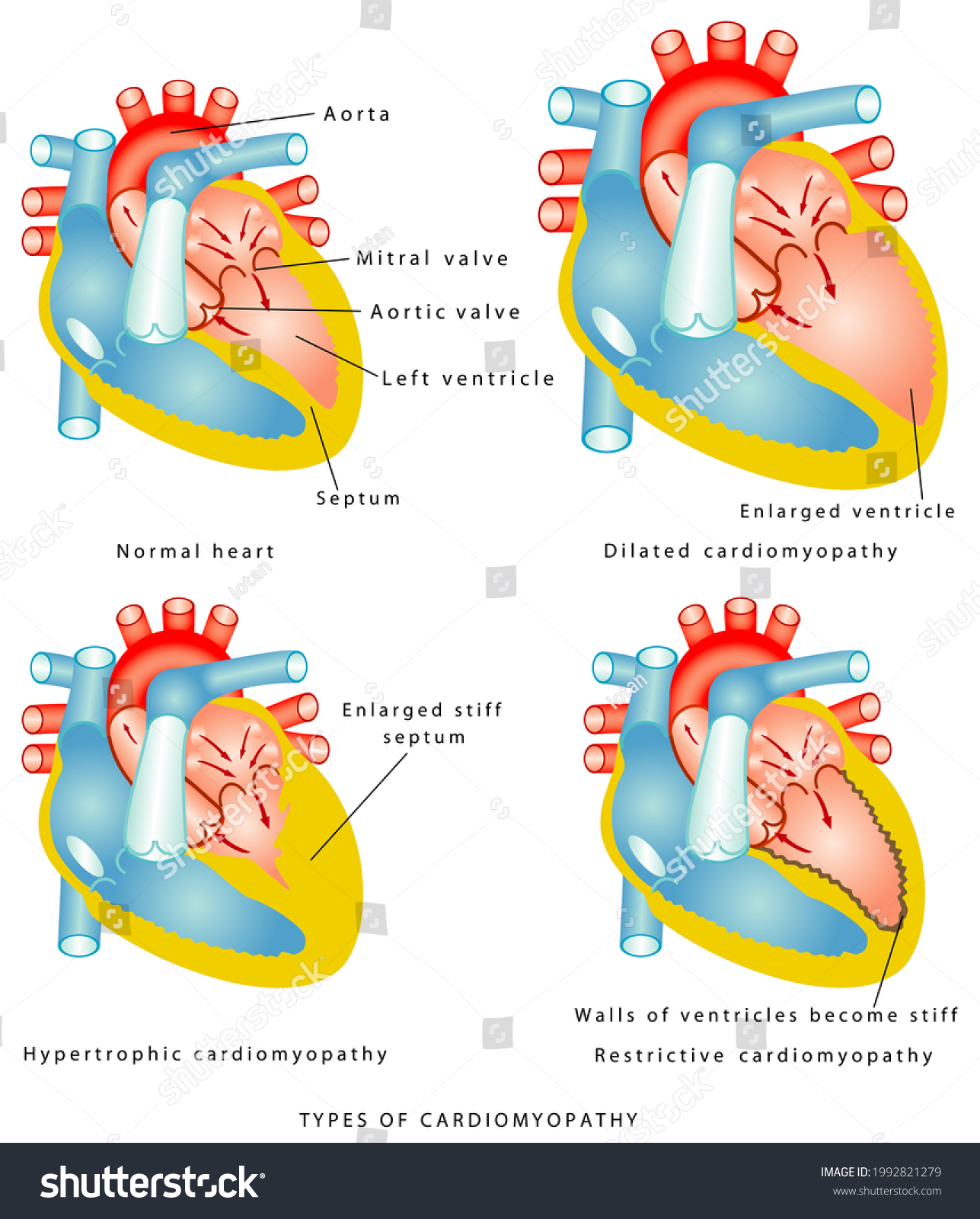 Types Cardiomyopathy Walls Ventricles Thicken Become Stock Illustration ...