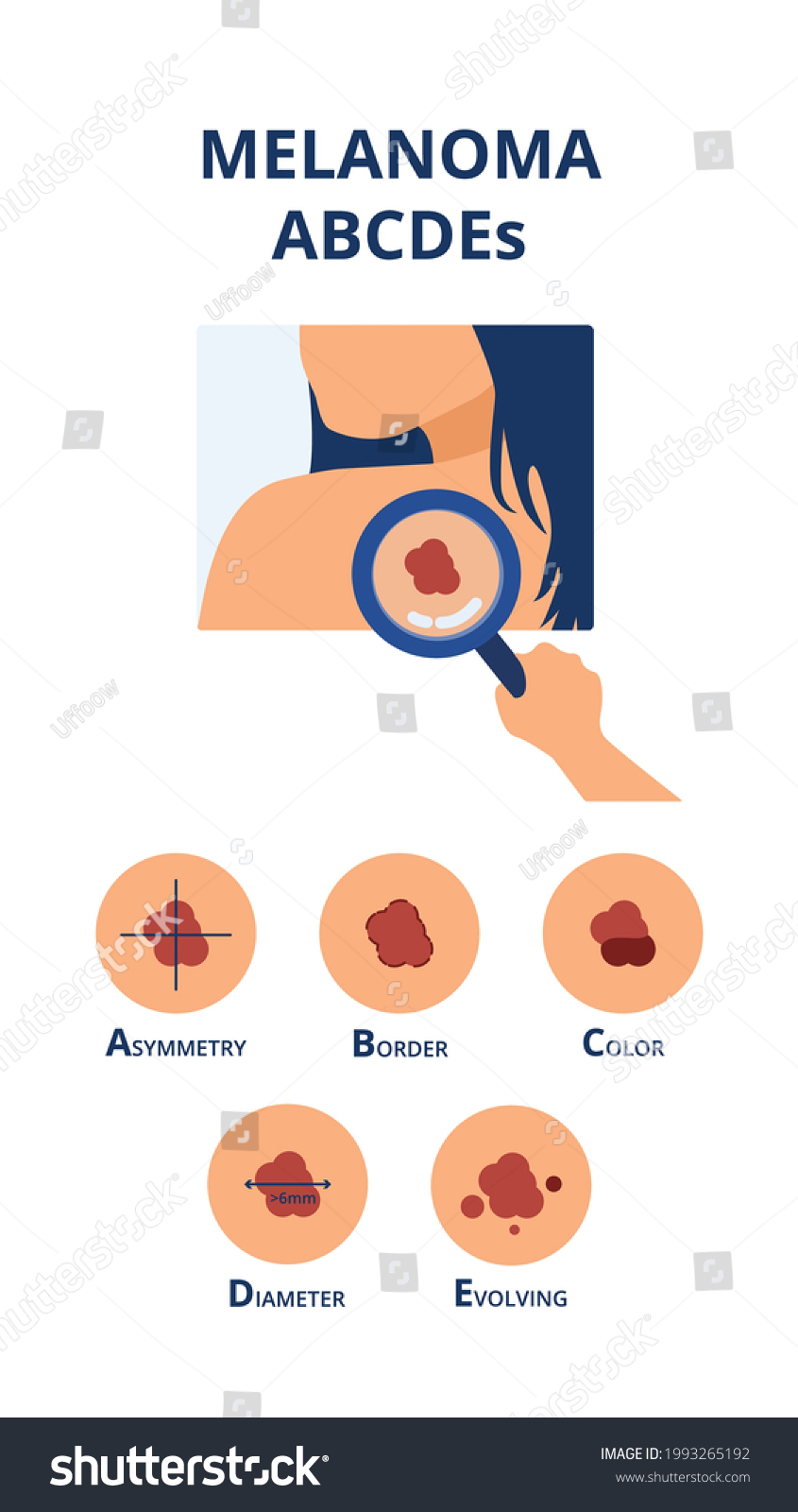 Melanoma Abcdes Symptoms Like Big Diameter Stock Vector (Royalty Free ...