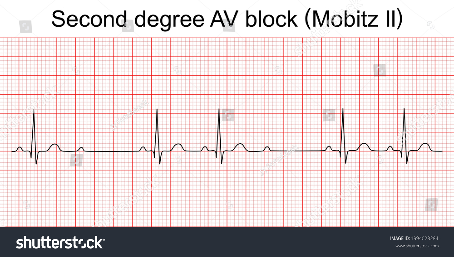 vektor-stok-electrocardiogram-show-second-degree-av-block-tanpa