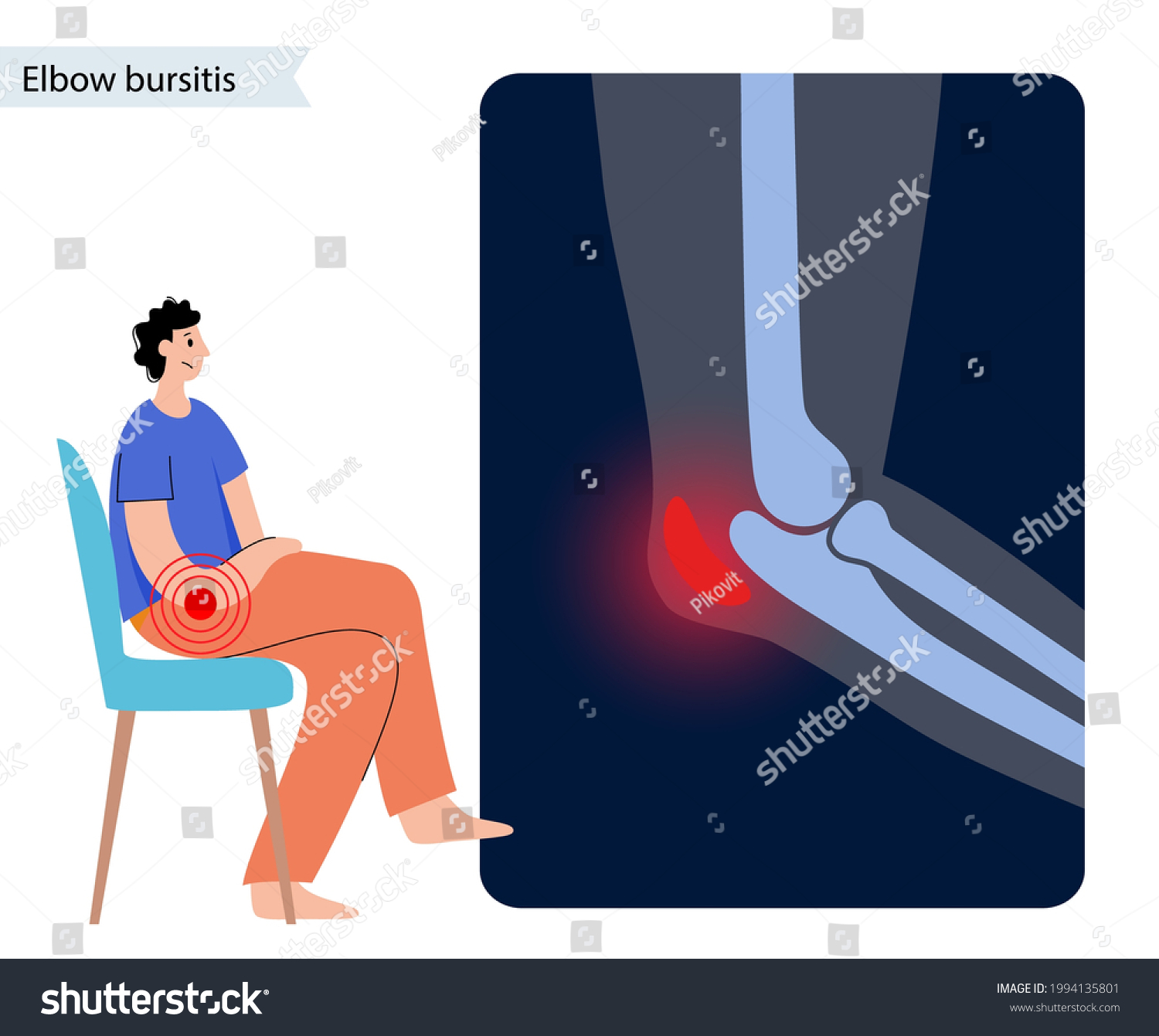 Olecranon Joint Bursitis Inflamed Bursa Student Stock Vector (Royalty ...