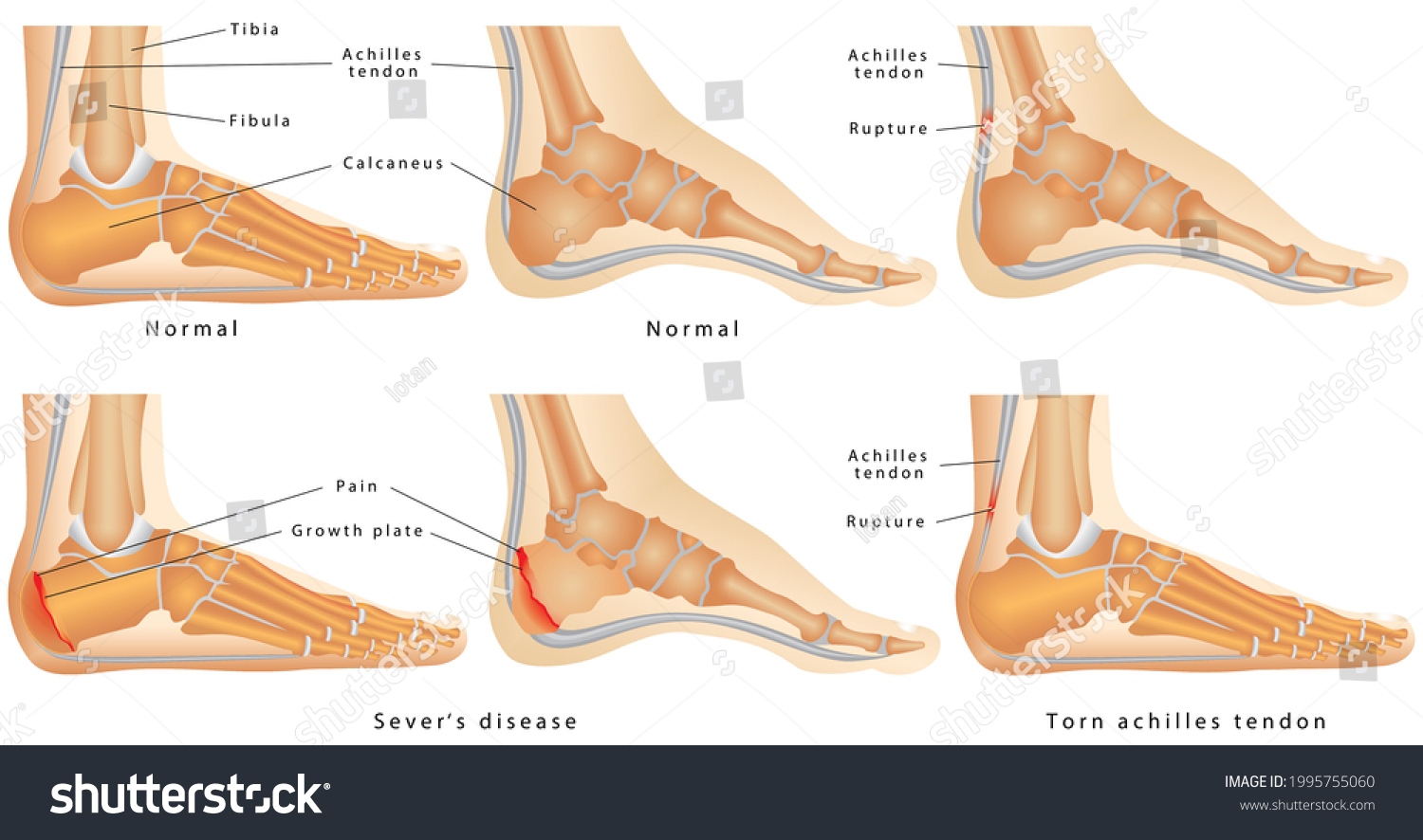 Ankleside View Ankle Disease Calcaneal Apophysitis Stock Illustration ...