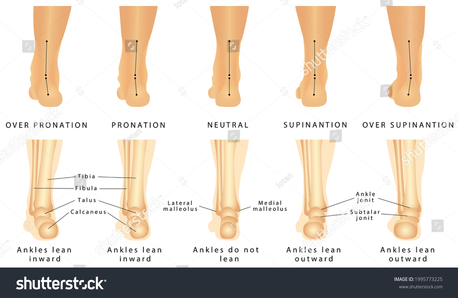 Foot Deformation Valgus Varus Defect Normal Ilustrações Stock