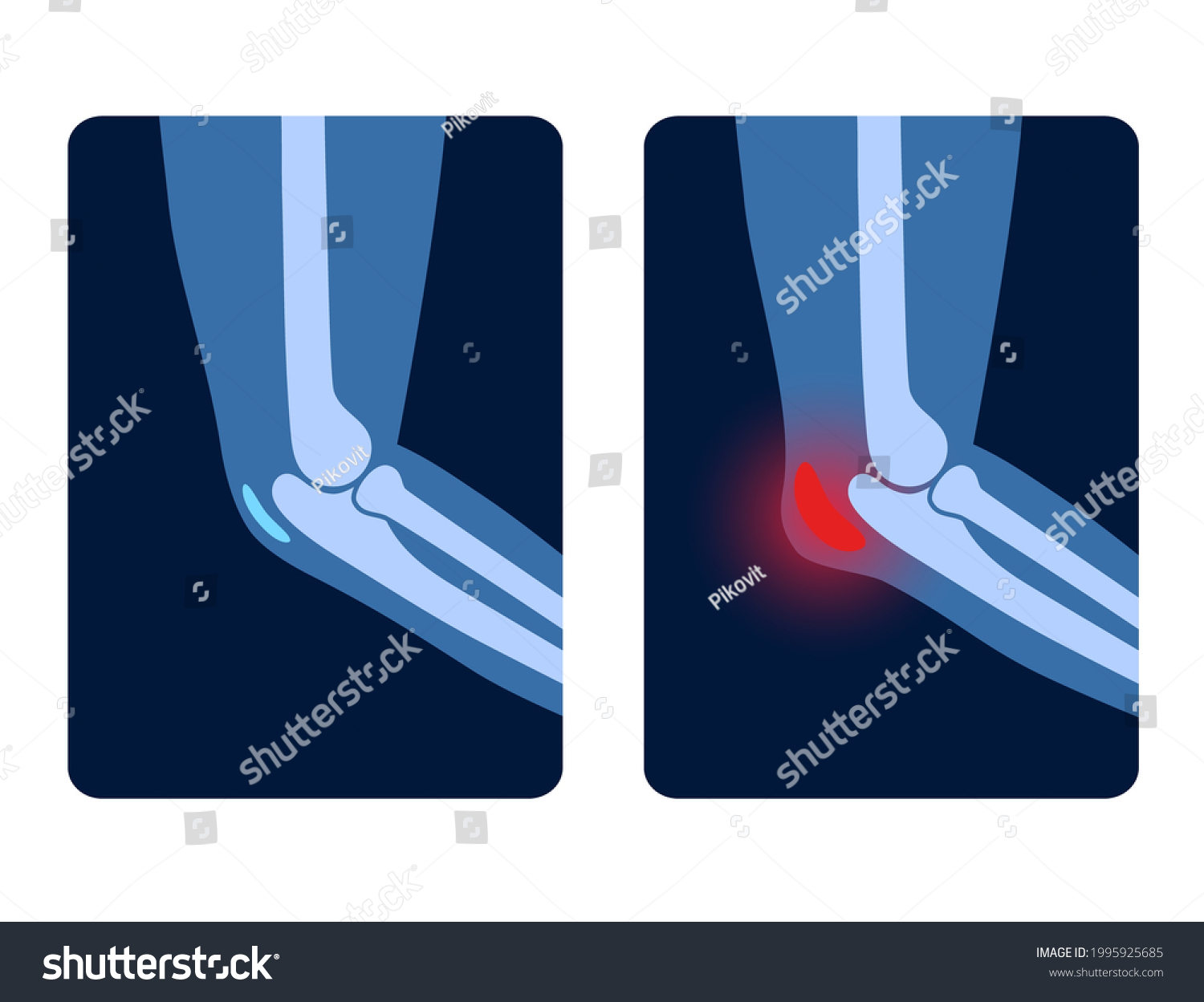 Olecranon Joint Bursitis Inflamed Bursa Student Stock Vector (Royalty ...