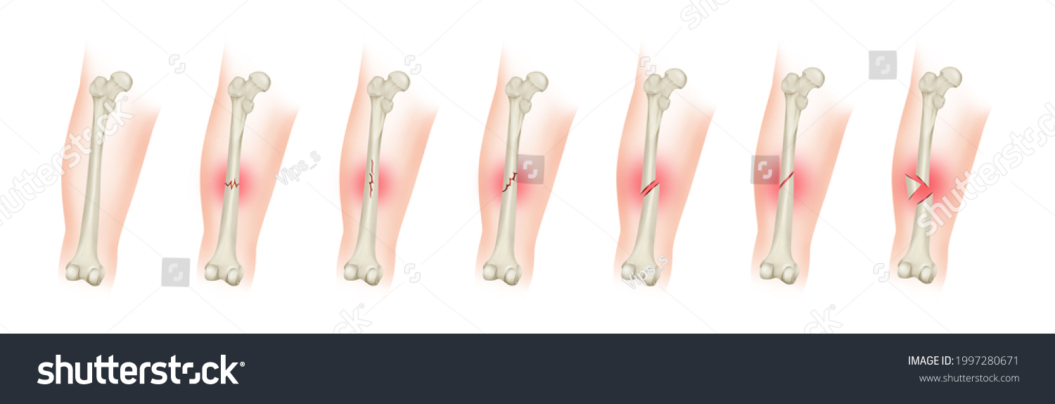 Types Bone Fractures Femoral Shaft Fracture Stock Illustration 1997280671 Shutterstock 