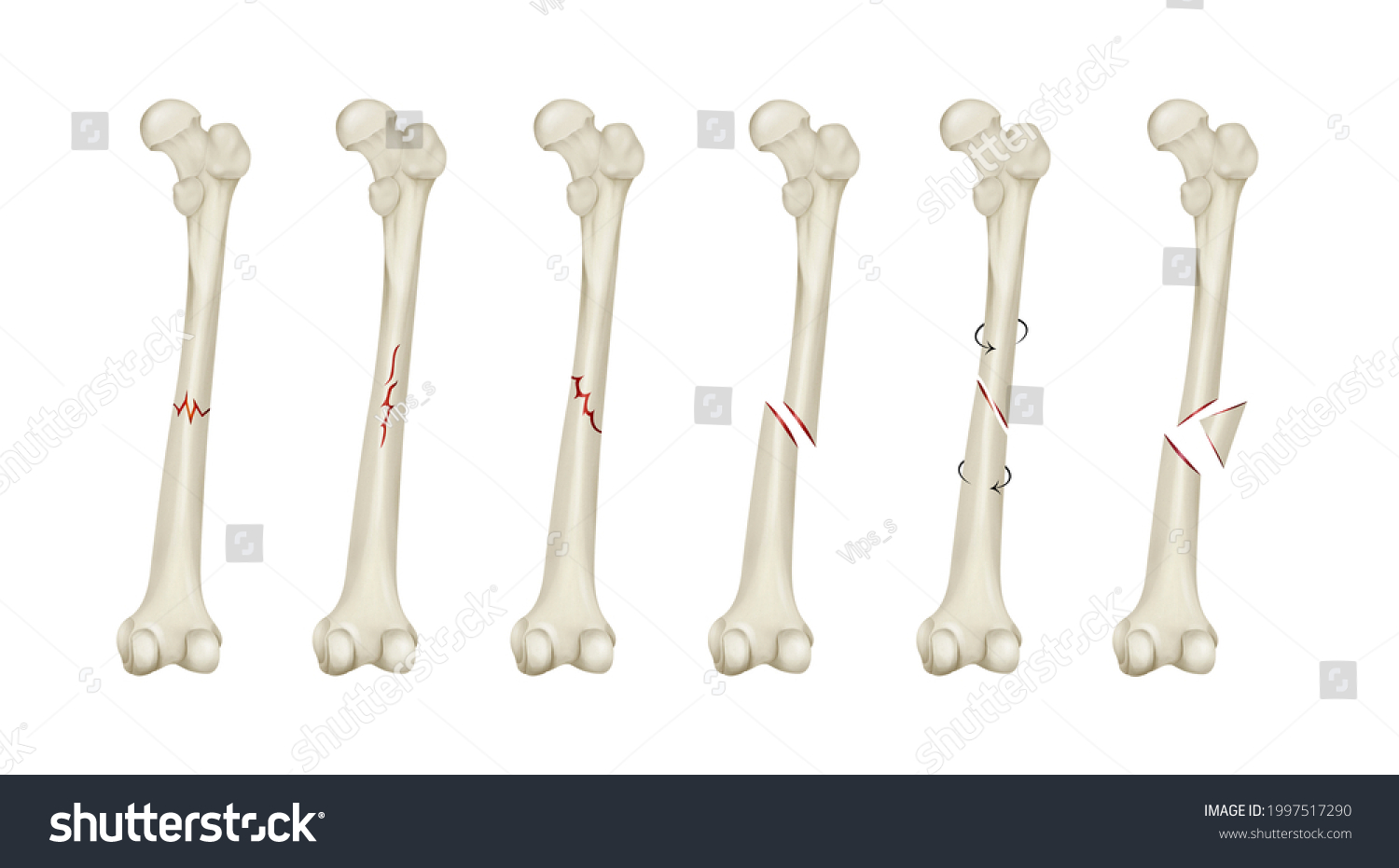 Types Bone Fractures Femoral Shaft Fracture Stock Illustration ...