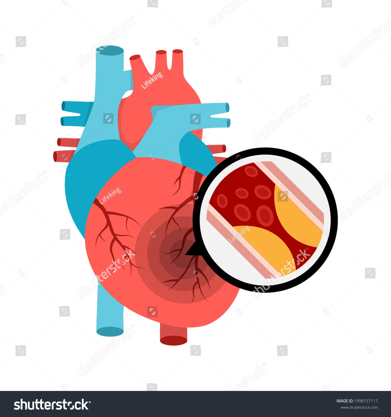 Human Heart Anatomy Heart Attack Atherosclerotic Stock Vector (Royalty ...