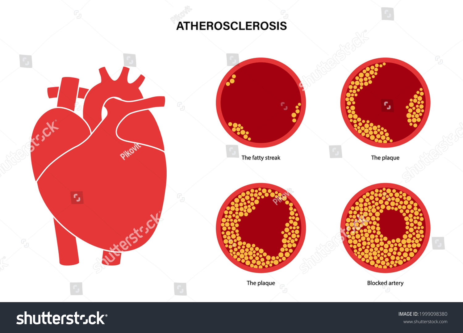 Cholesterol Human Blood Vessels Heart Logo Stock Vector (Royalty Free ...