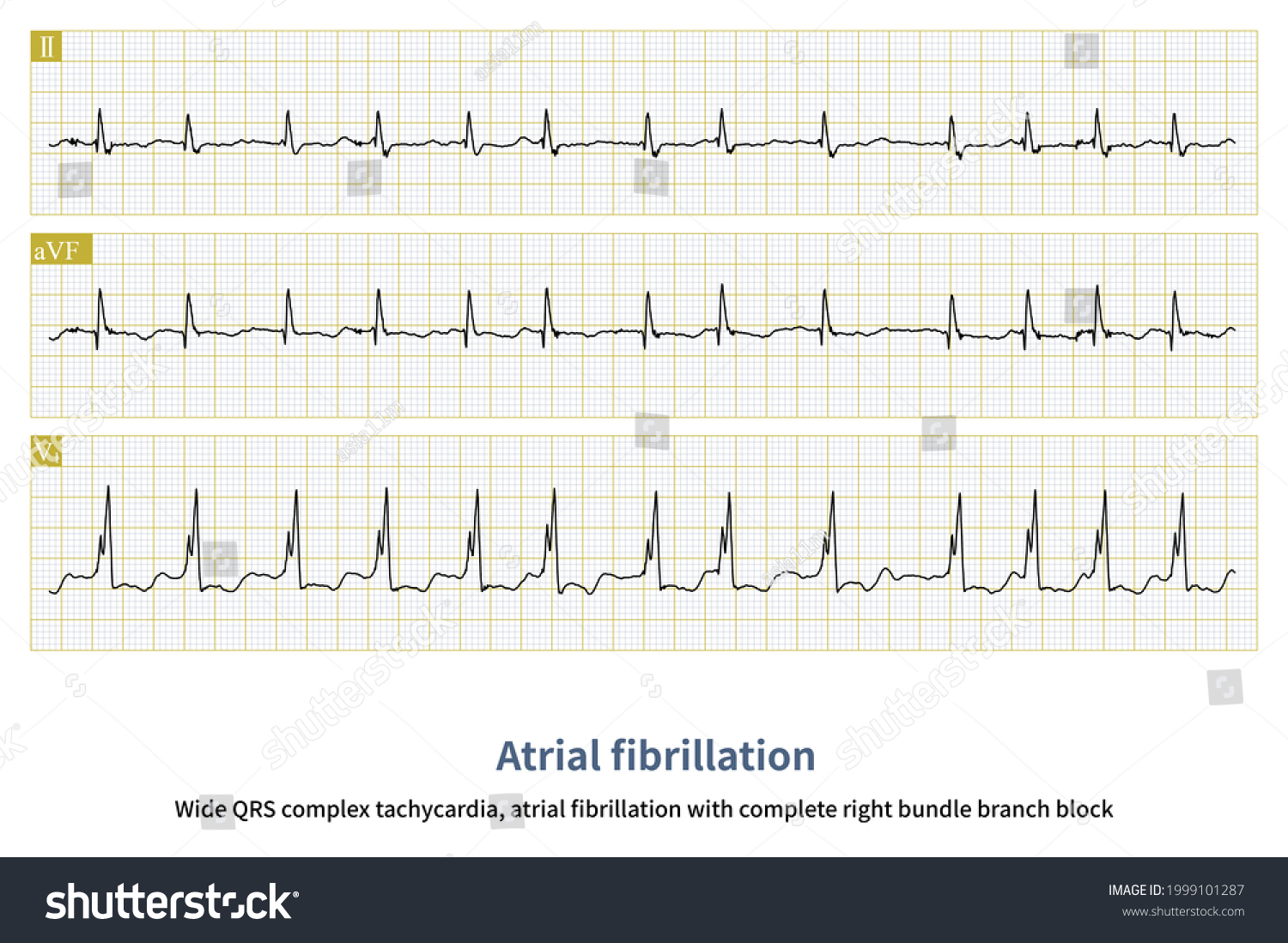 Sometimes Atrial Fibrillation Waves Very Subtle Stock Illustration ...