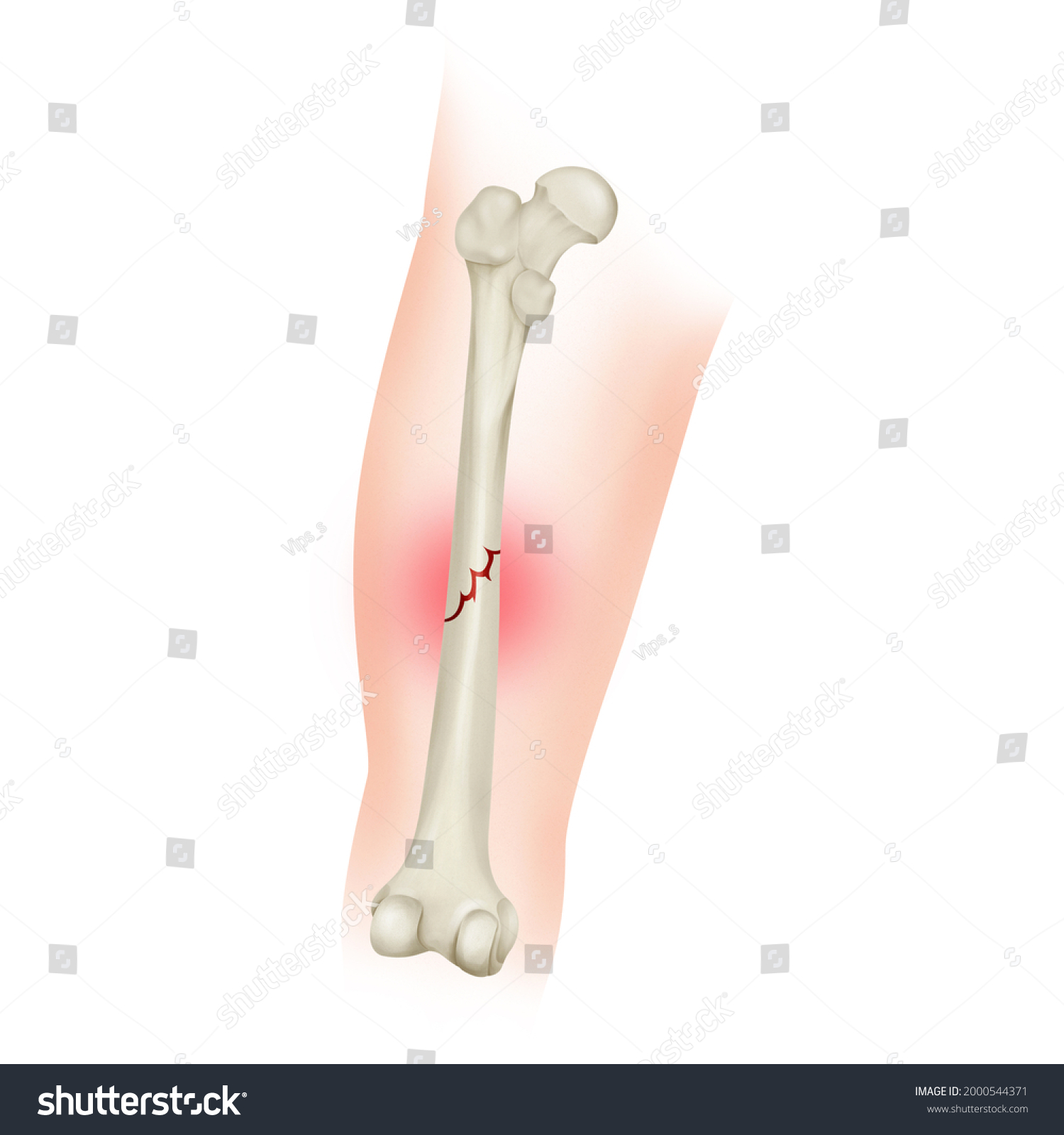 Nondisplaced Bone Fracture Femoral Shaft Fracture Stock Illustration