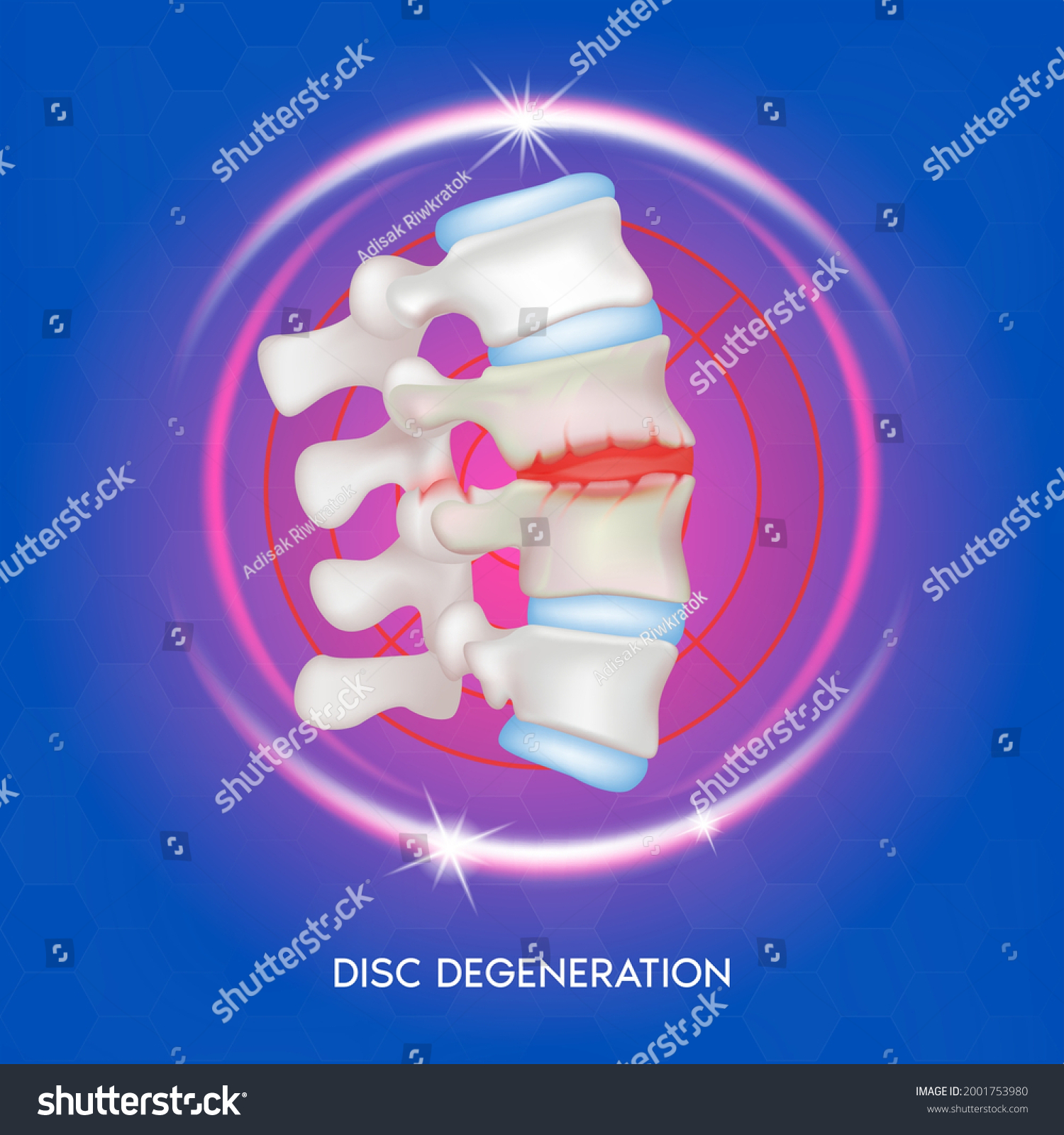 Disc Degeneration Spine Diseases Intervertebral Discs Stock Vector ...