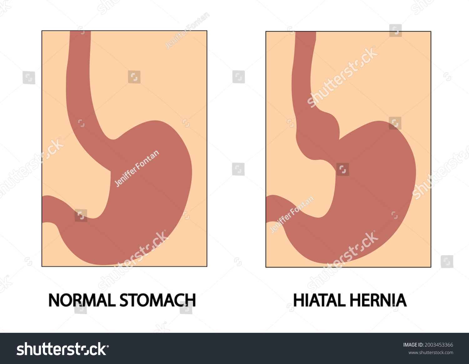 Hiatus Hernia Hiatal Hernia Types Hiatal Stock Illustration 2003453366 Shutterstock 6067