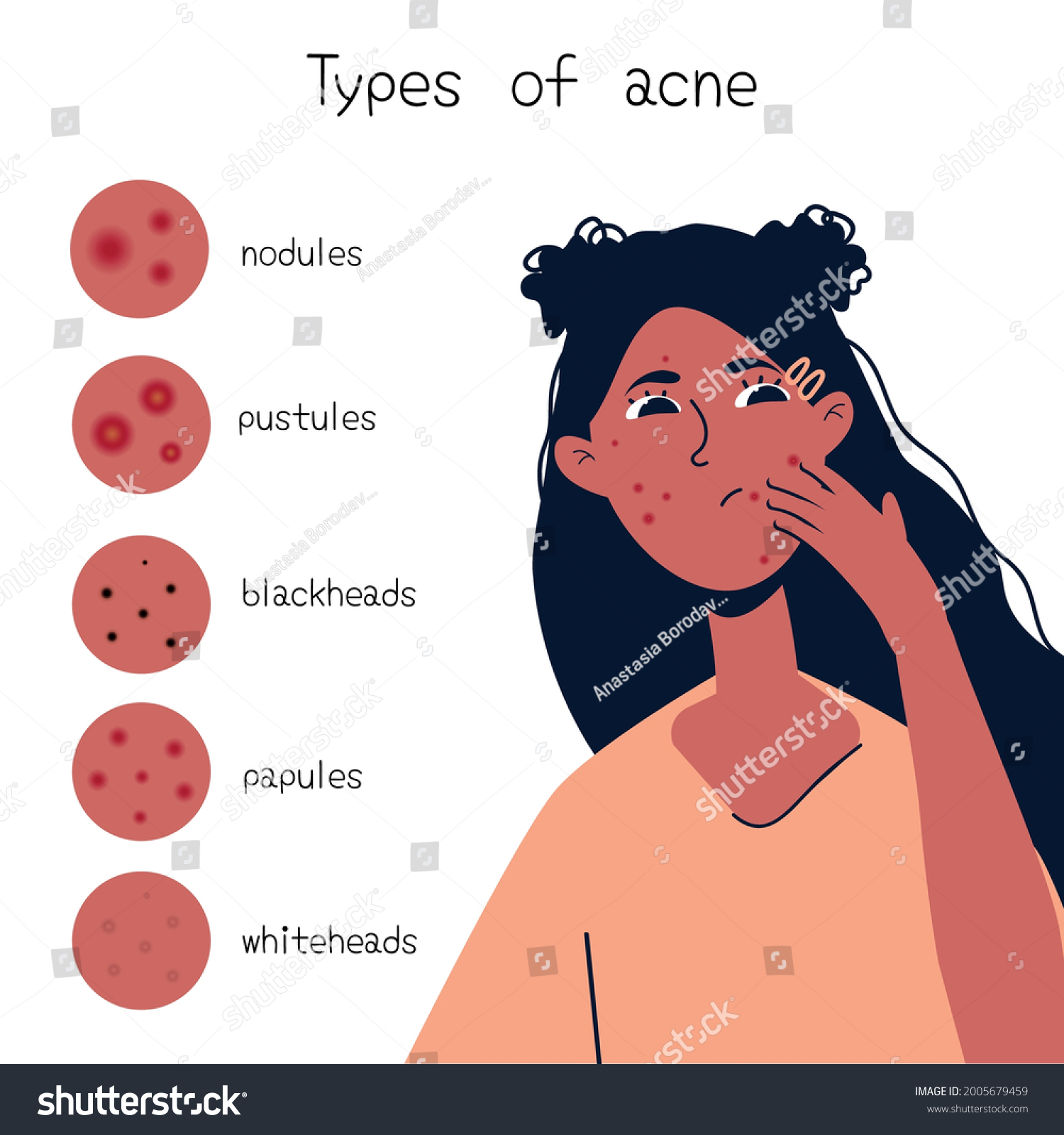 Acne Types Chart Vector Illustration Skin Stock Vector Royalty Free