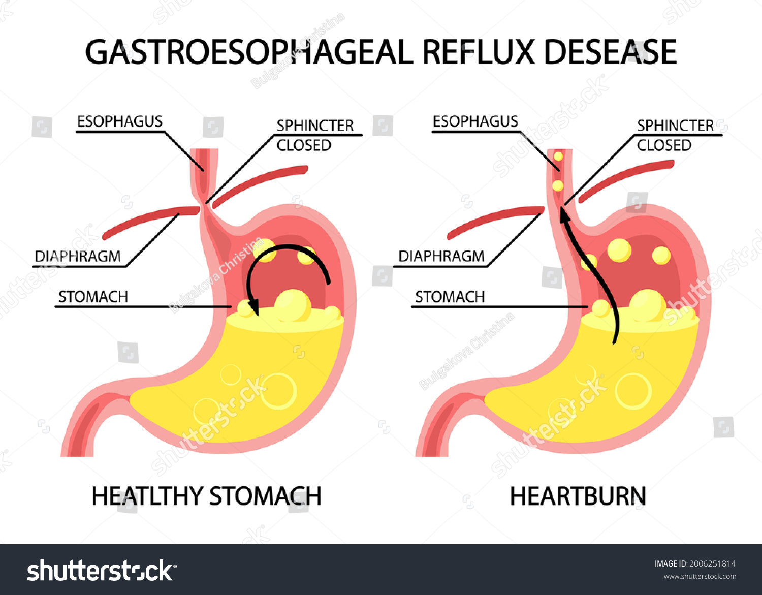 Human Stomach Gastroesophageal Reflux Disease Gerd Stock Vector ...