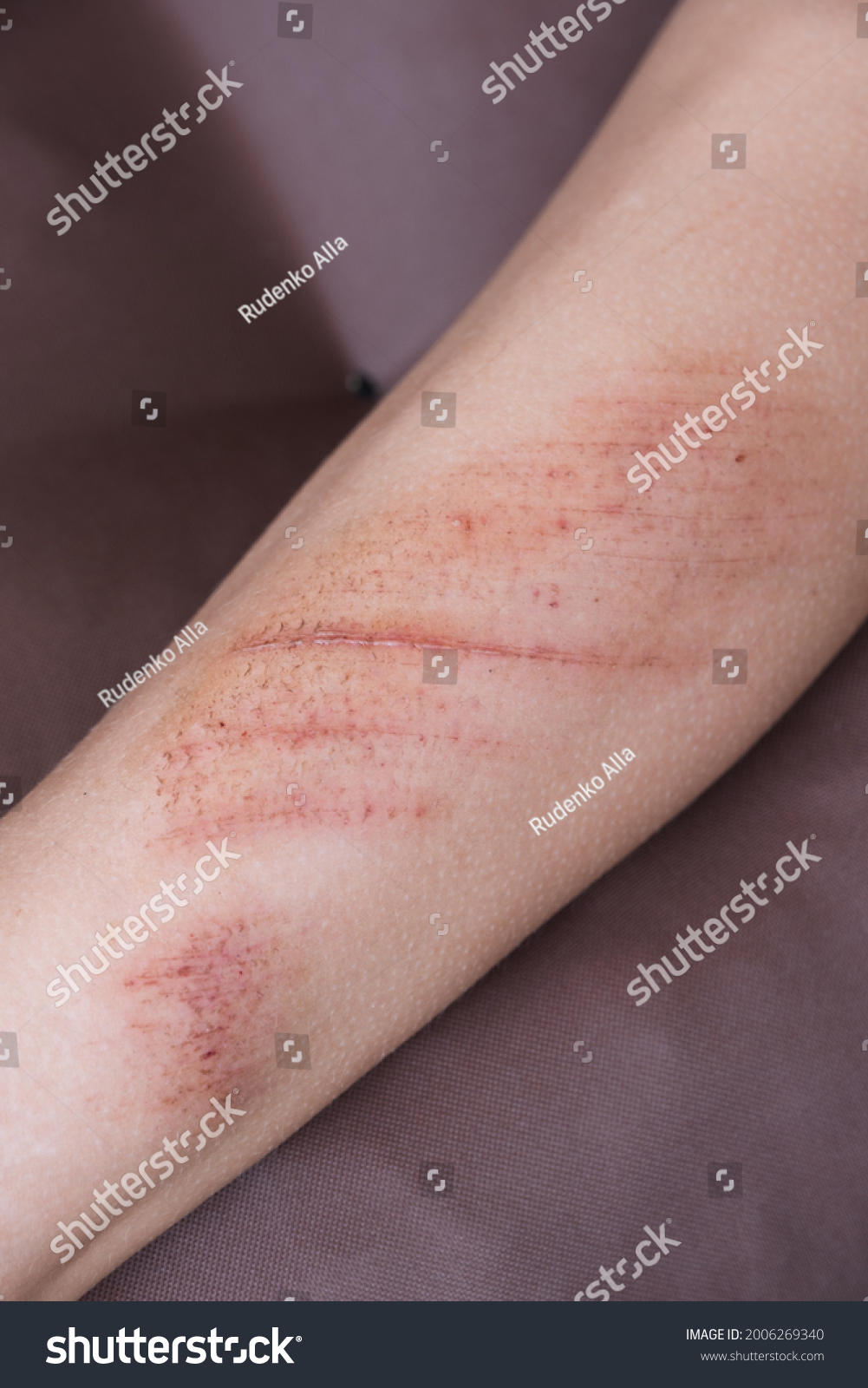 7 936 Imagens De Skin Abrasion Imagens Fotos Stock E Vetores Shutterstock