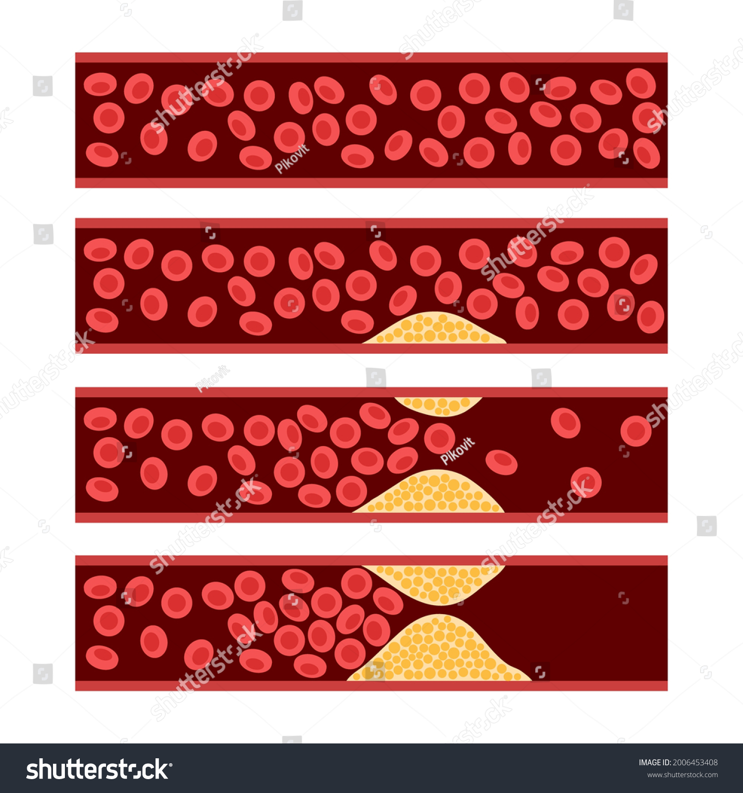 Arteriosclerosis Infarct Ischemia Thrombosis Disease Cholesterol Stock ...