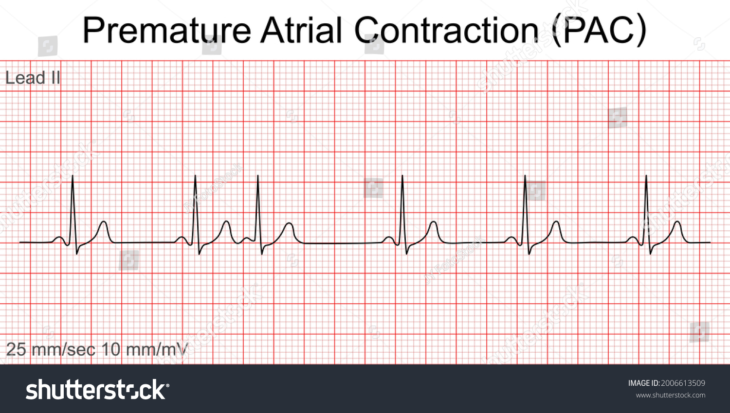 premature atrial contraction strip