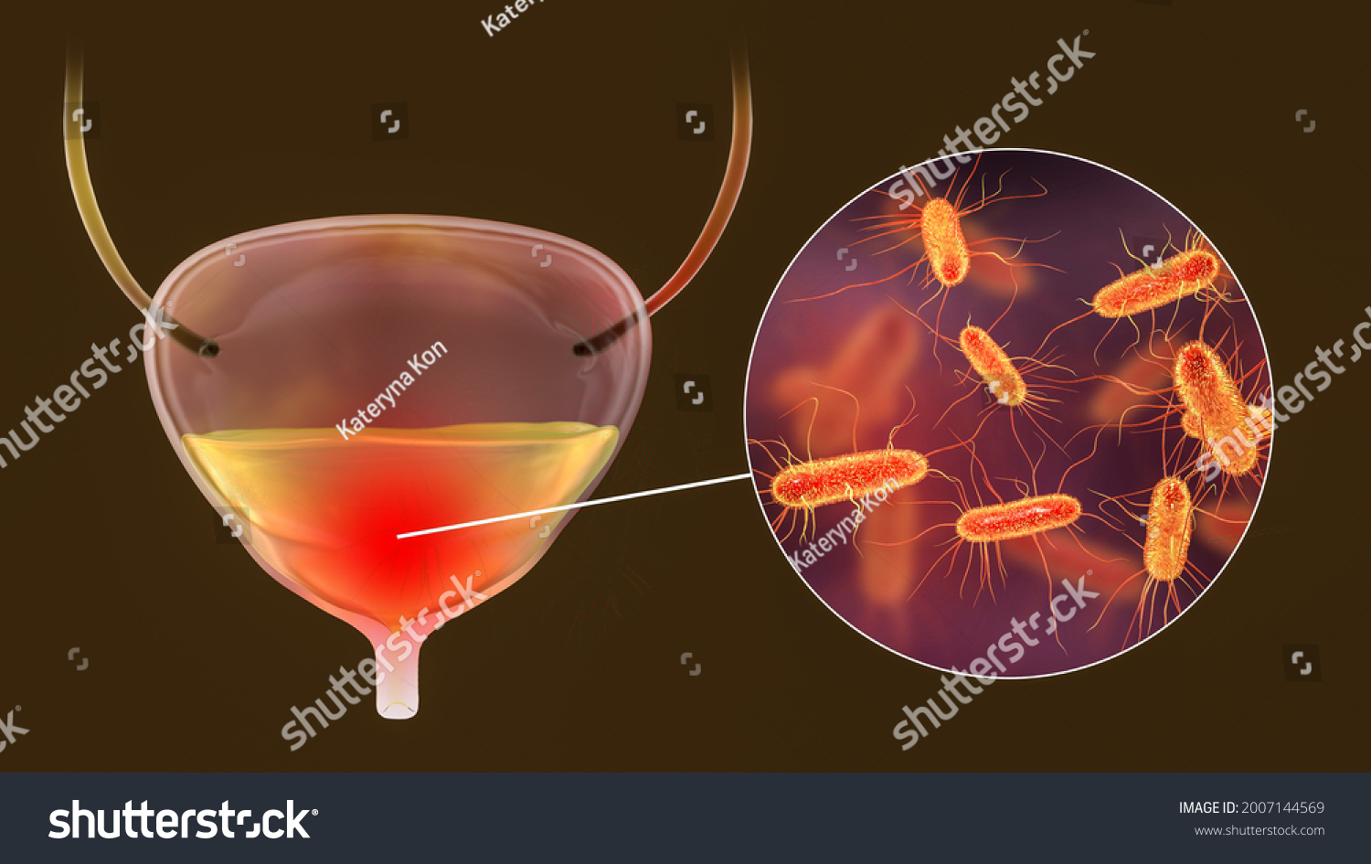 Cystitis Bacterial Infection Urinary Bladder Conceptual Stock Illustration 2007144569 Shutterstock 8495