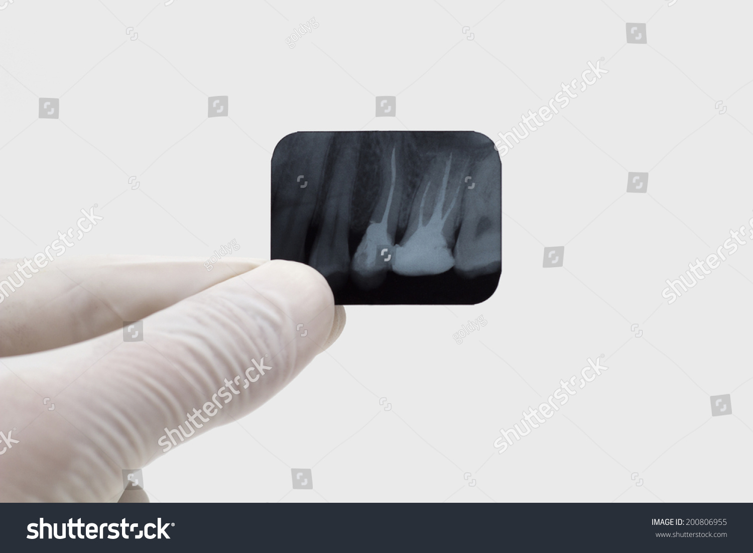 Dental Xray Isolated On White Background Stock Photo 200806955 ...