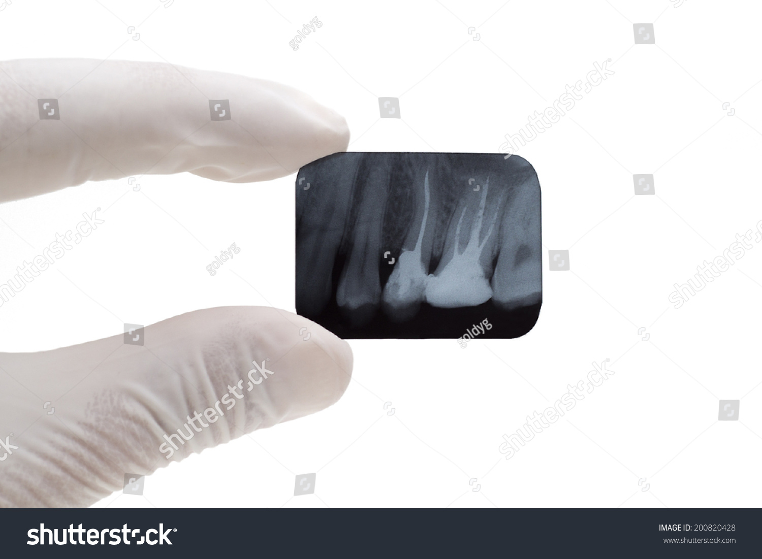 Human Teeth On Xray Isolated On Stock Photo 200820428 | Shutterstock