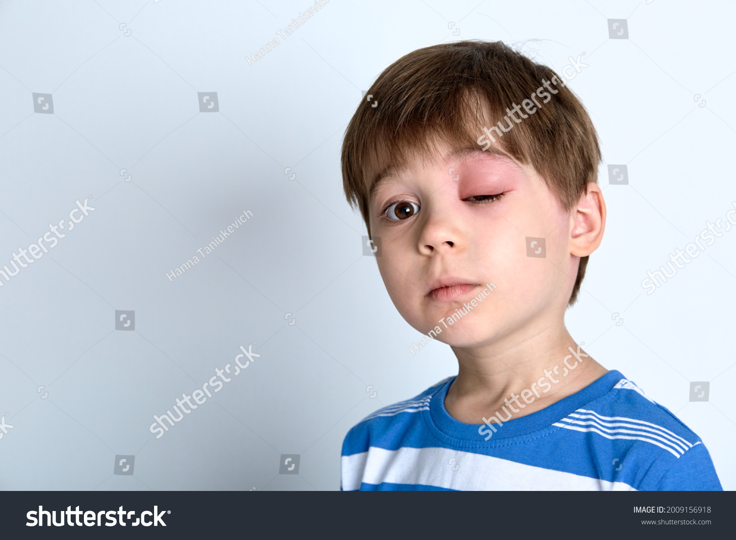 Boy Swollen Eye Insect Bite Quincke Stock Photo 2009156918 Shutterstock
