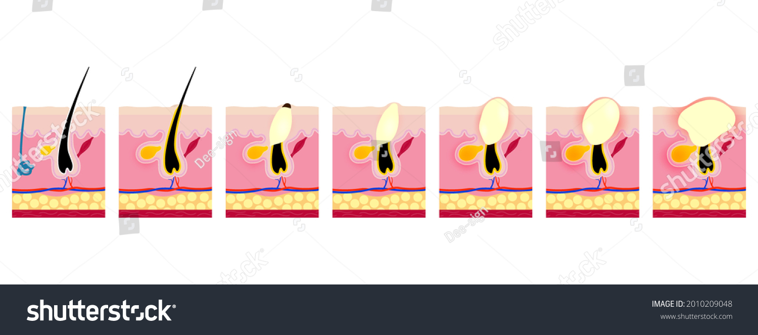 Stage Acne Development Inflammation Process Stock Vector (royalty Free 