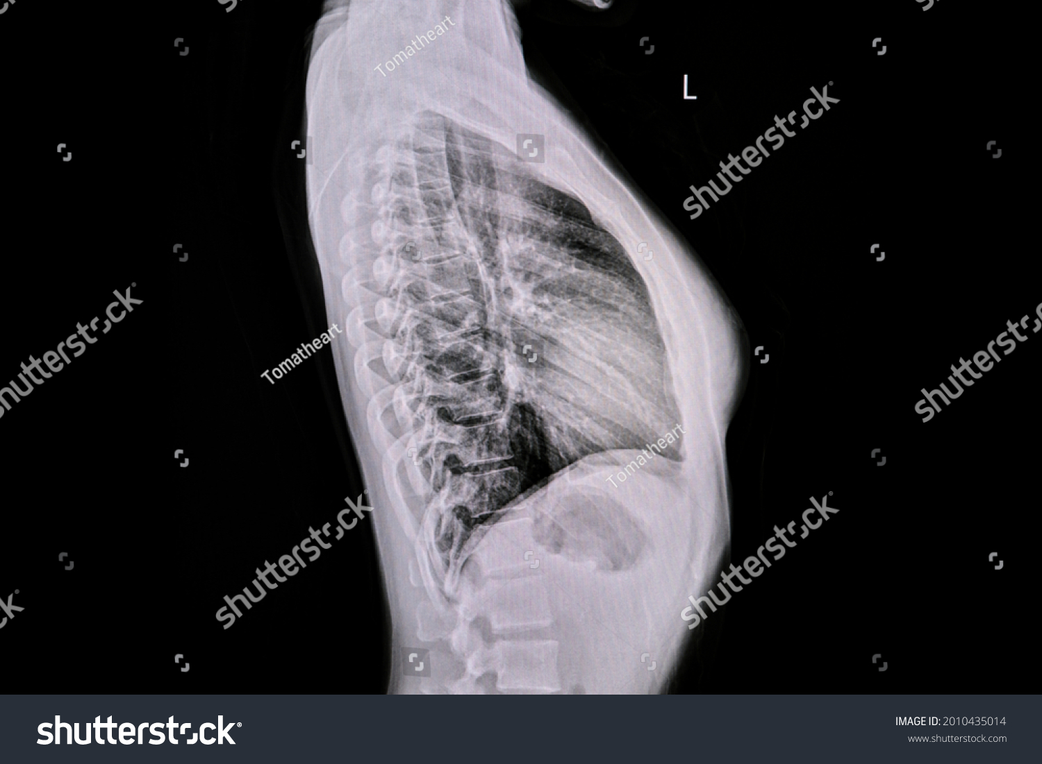 Chest Xray Normal Female Subject Lateral Stock Photo Shutterstock