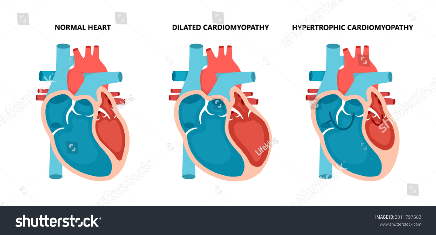 Types Heart Diseases Normal Hypertrophic Dilated Stock Vector (Royalty ...