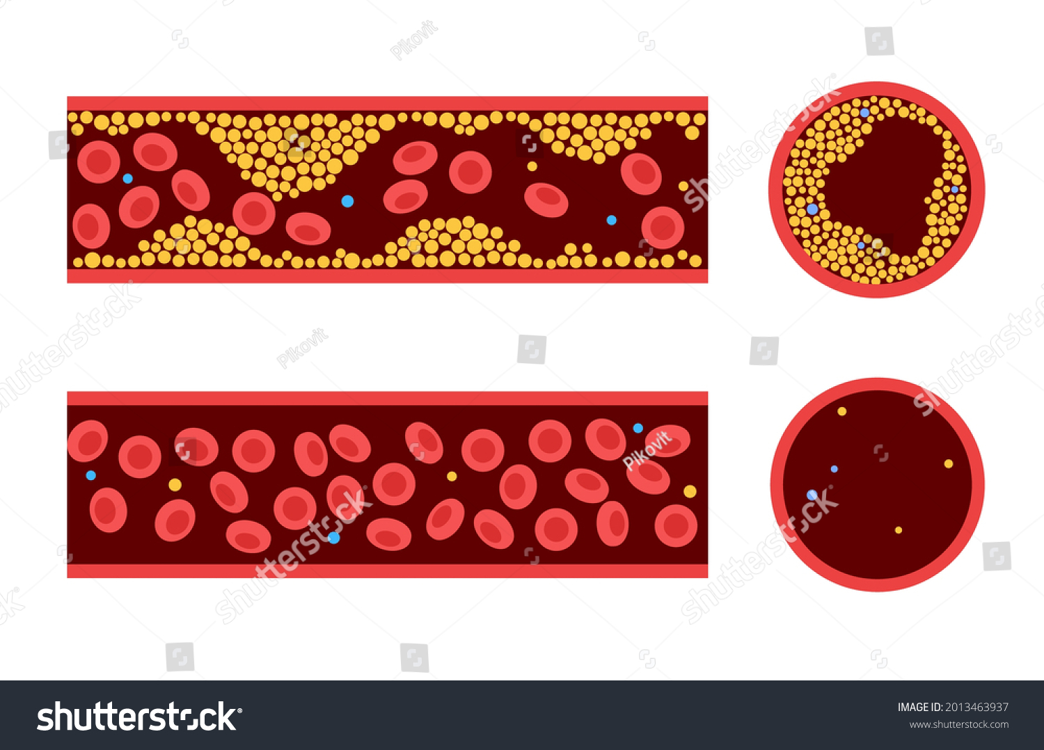 Cholesterol Human Blood Vessels Fat Cells Stock Vector (Royalty Free ...