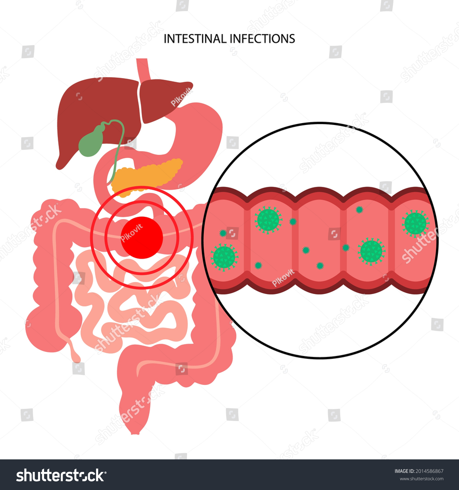 Gastrointestinal Infections Concept Viral Bacterial Parasitic Stock ...