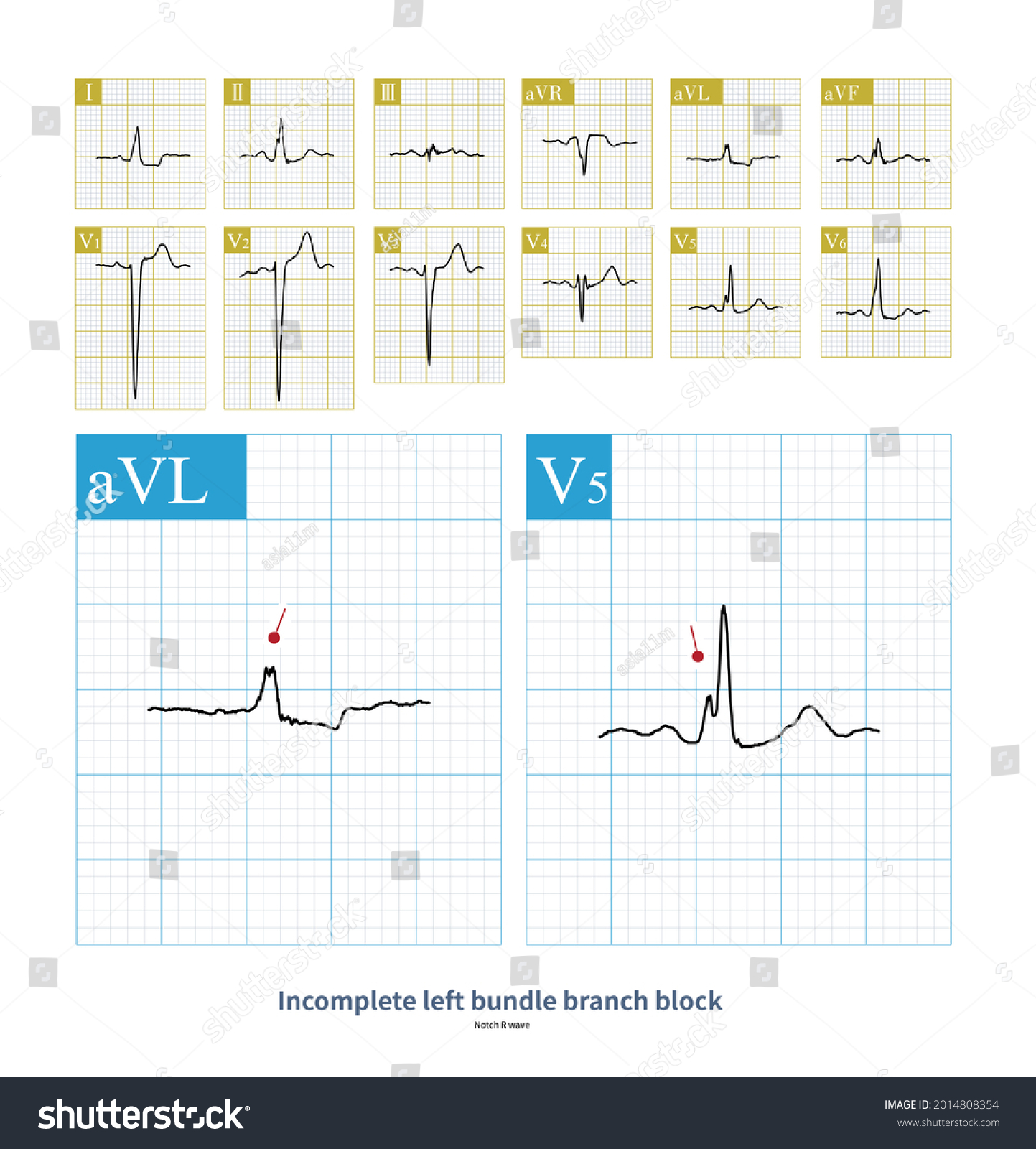 Qrs Duration Ecg 110 120ms Left Stock Illustration 2014808354 ...