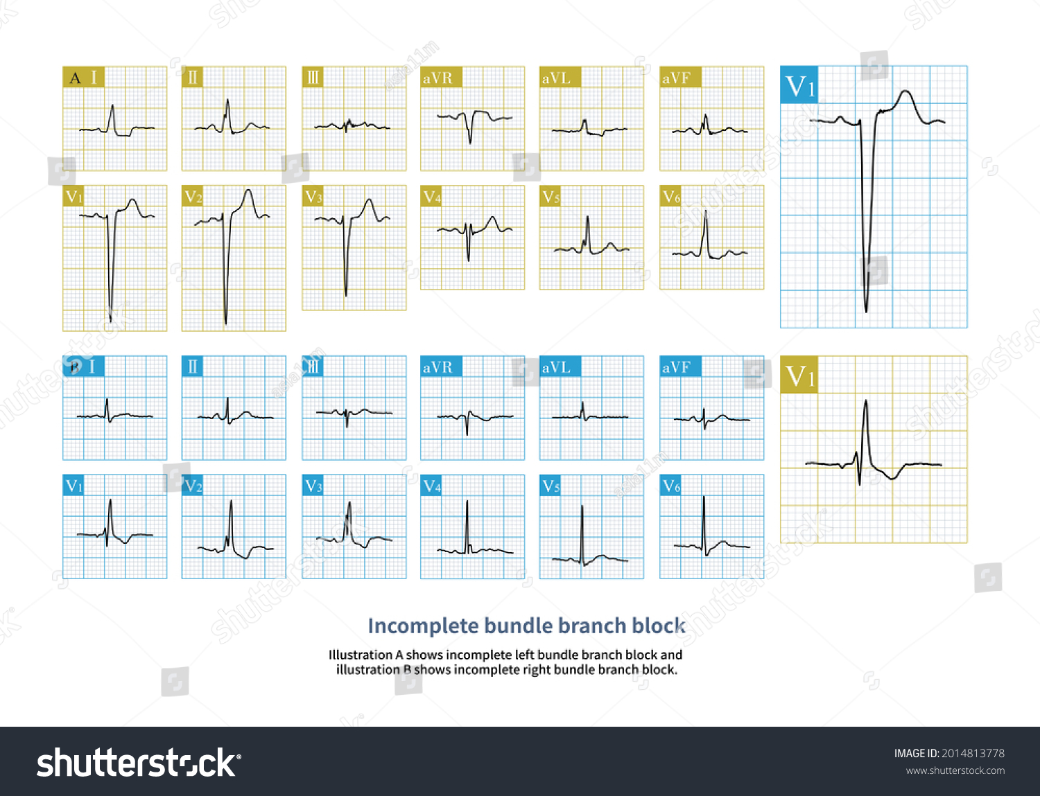 When Qrs Interval Between 110 120ms Stock Illustration 2014813778 ...