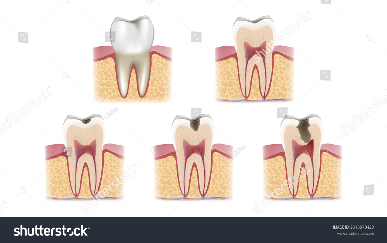 Schematic Sectional View Stages Caries Development Stock Vector ...