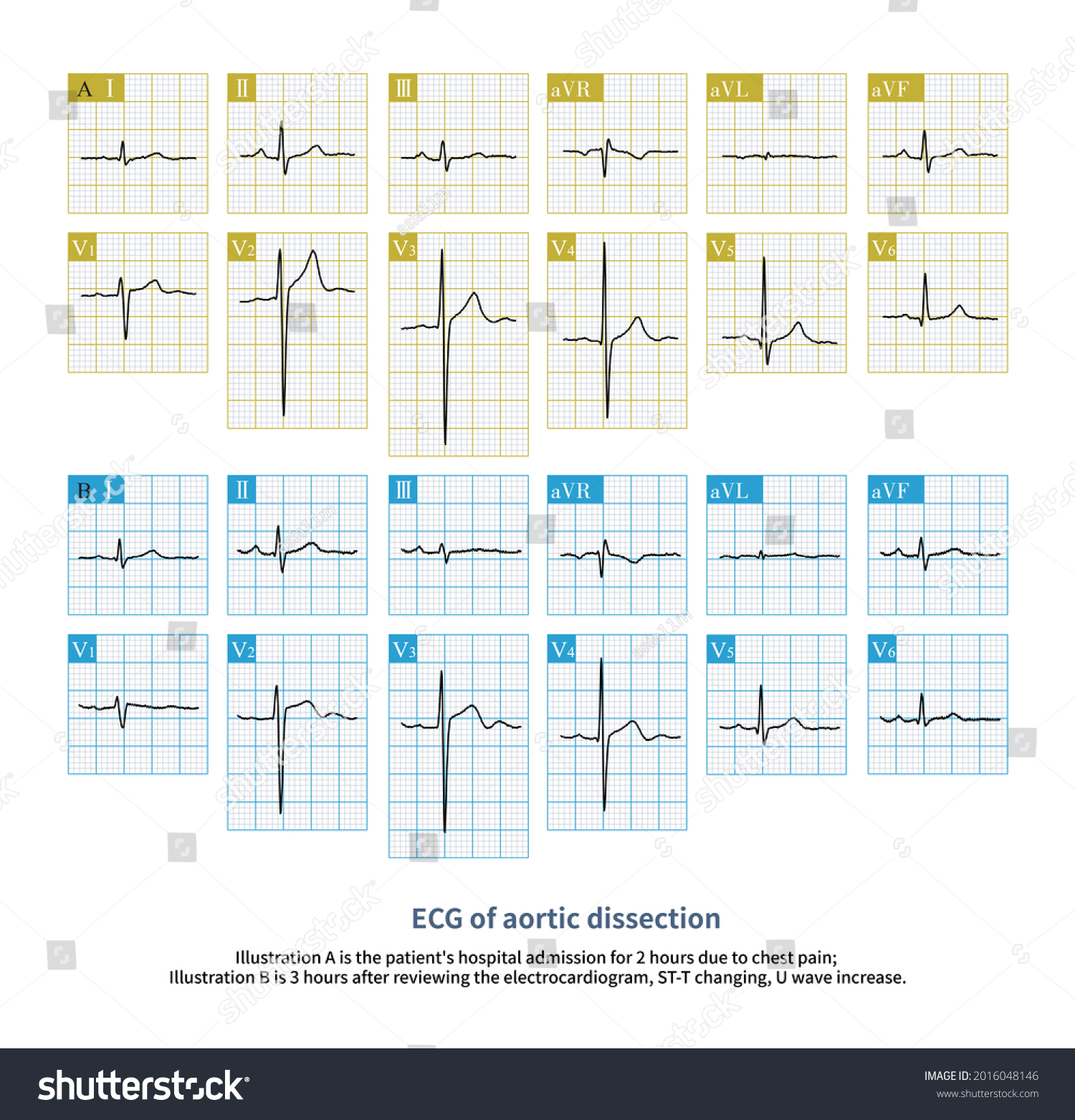 Aortic Dissection Important Differential Diagnosis Acute Stock ...