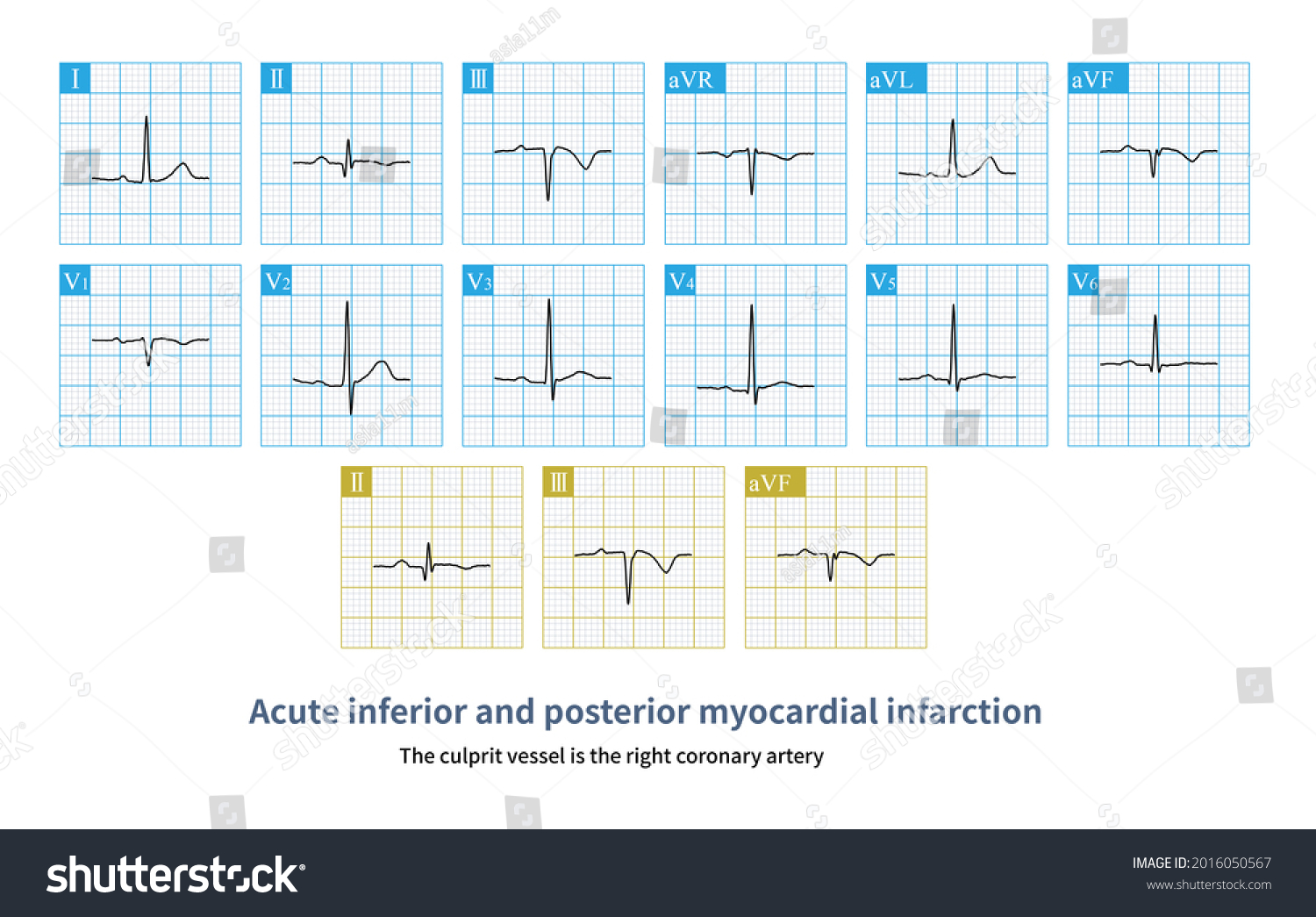 Male 54 Years Old Chest Pain Stock Illustration 2016050567 | Shutterstock