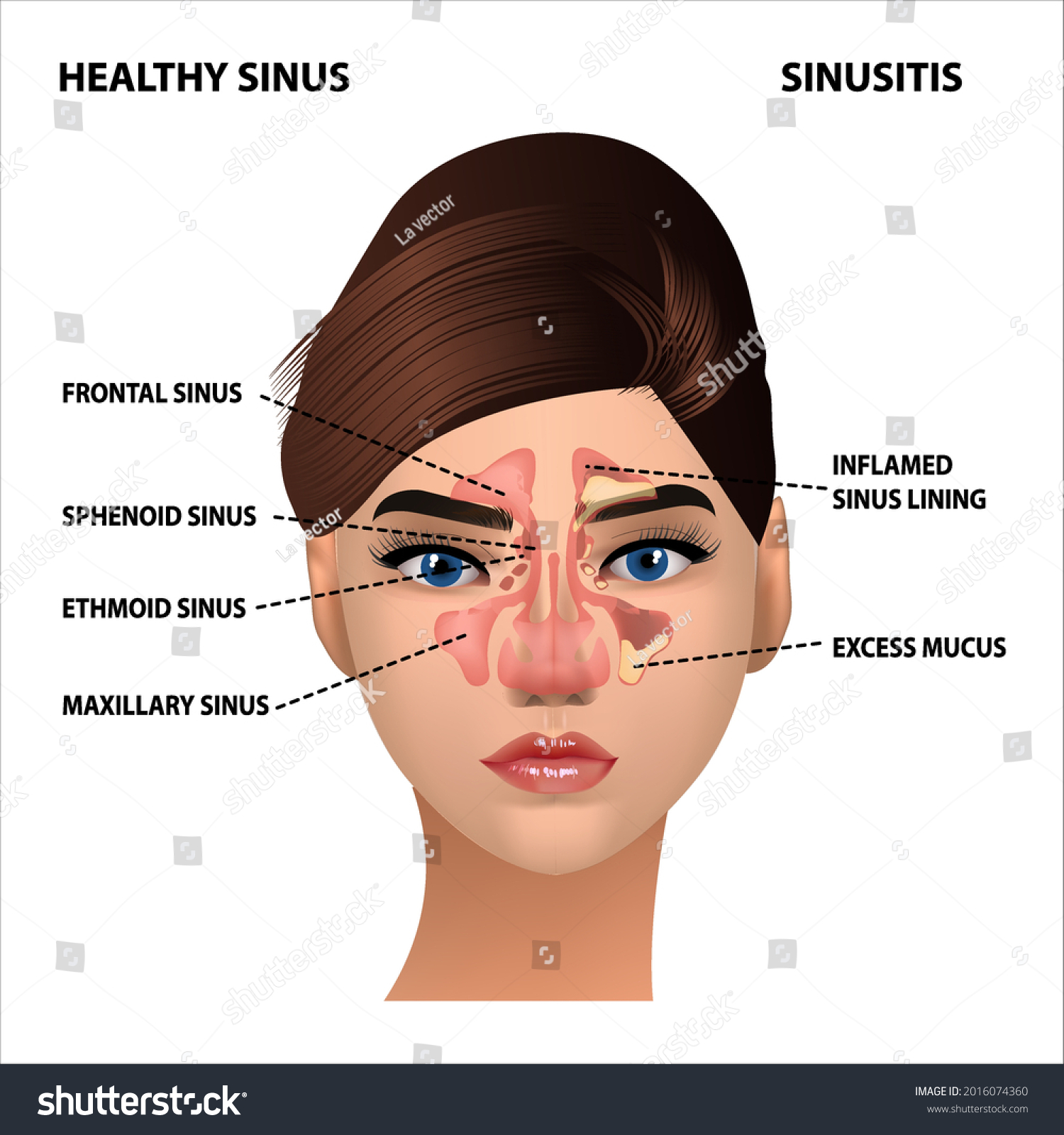 Sinusitis Healthy Sinus Infections Signs Realistic Stock Vector ...