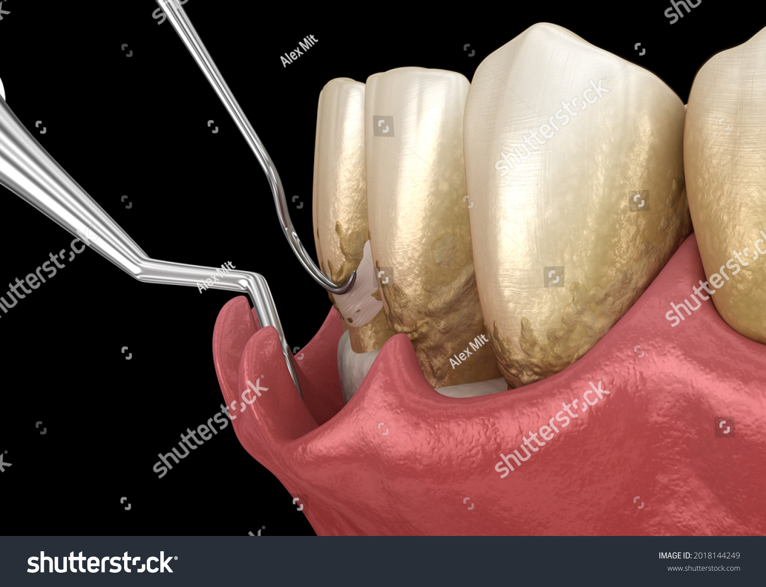 Open Curettage Scaling Root Planing Conventional Stock Illustration ...