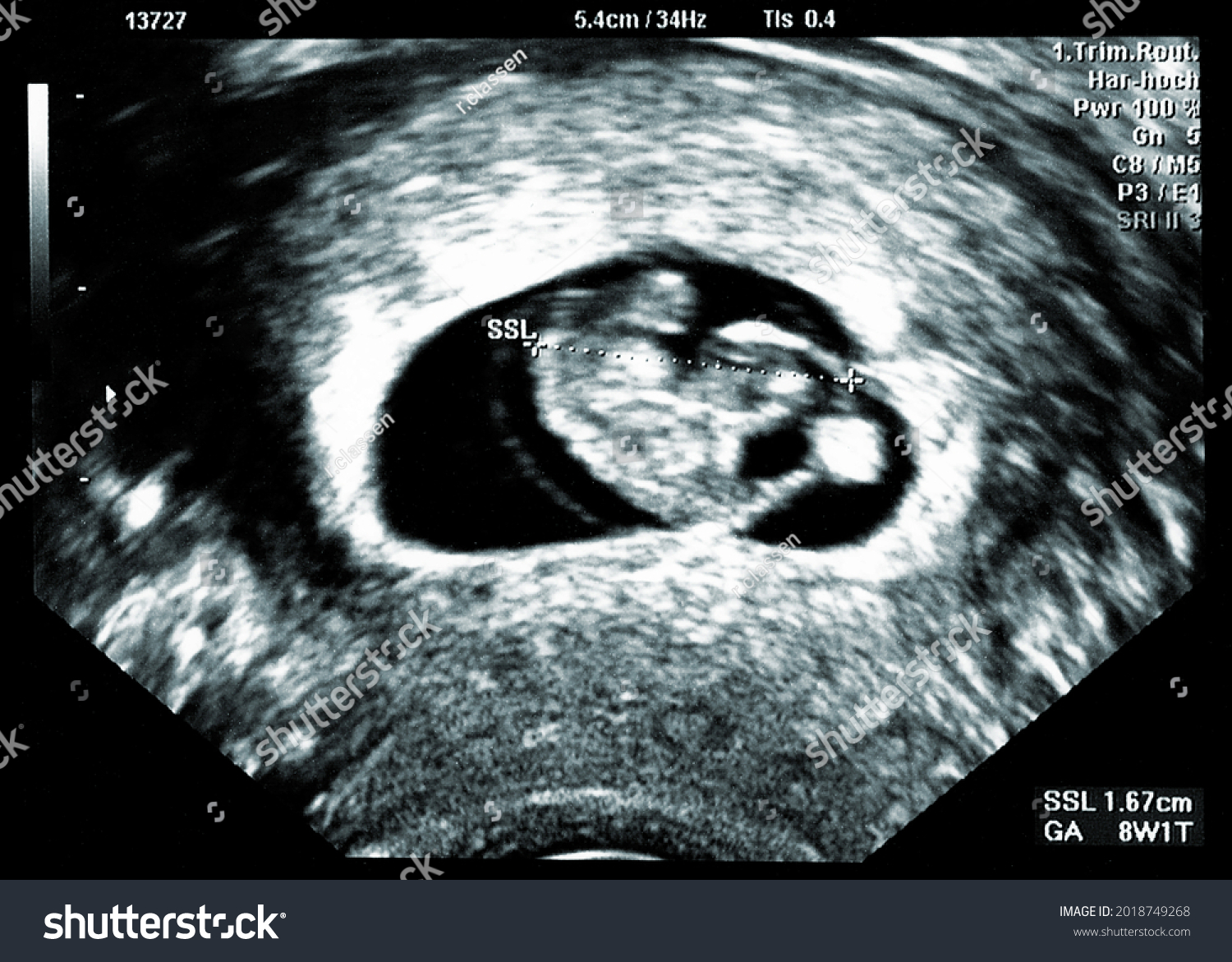 8 weeks pregnant baby size in mm ultrasound