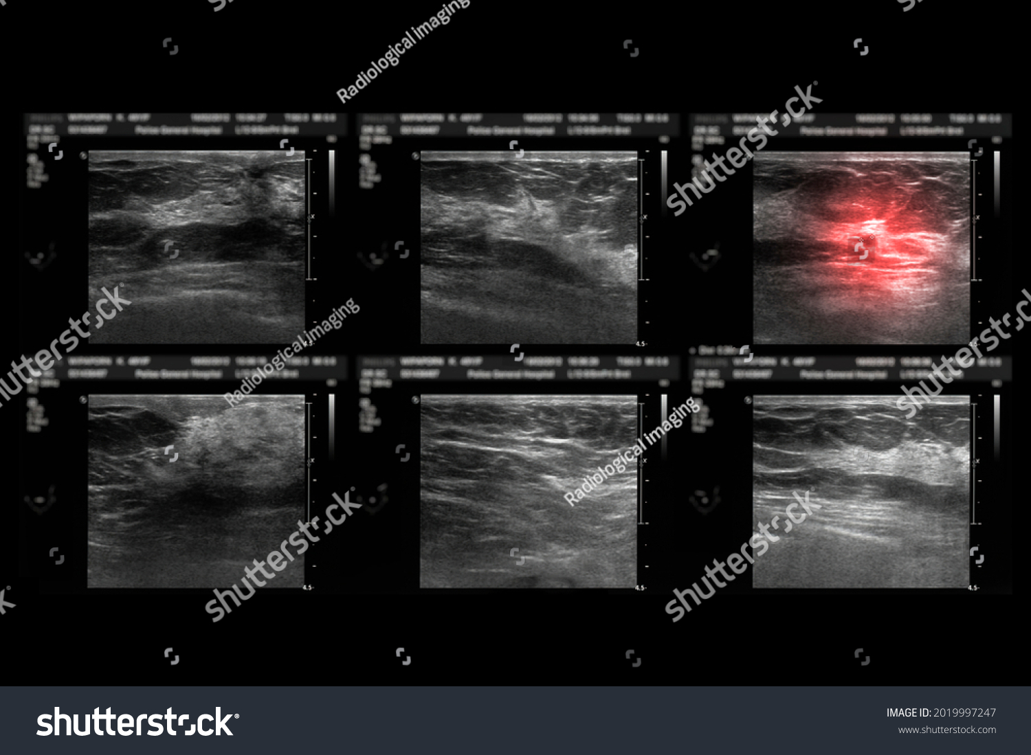 Ultrasound Breast After Mammography Diagnonsis Breast Stock