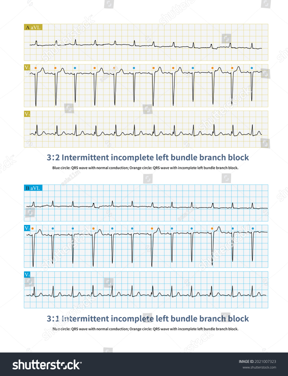 incomplete-left-bundle-branch-block-32-stock-illustration-2021007323