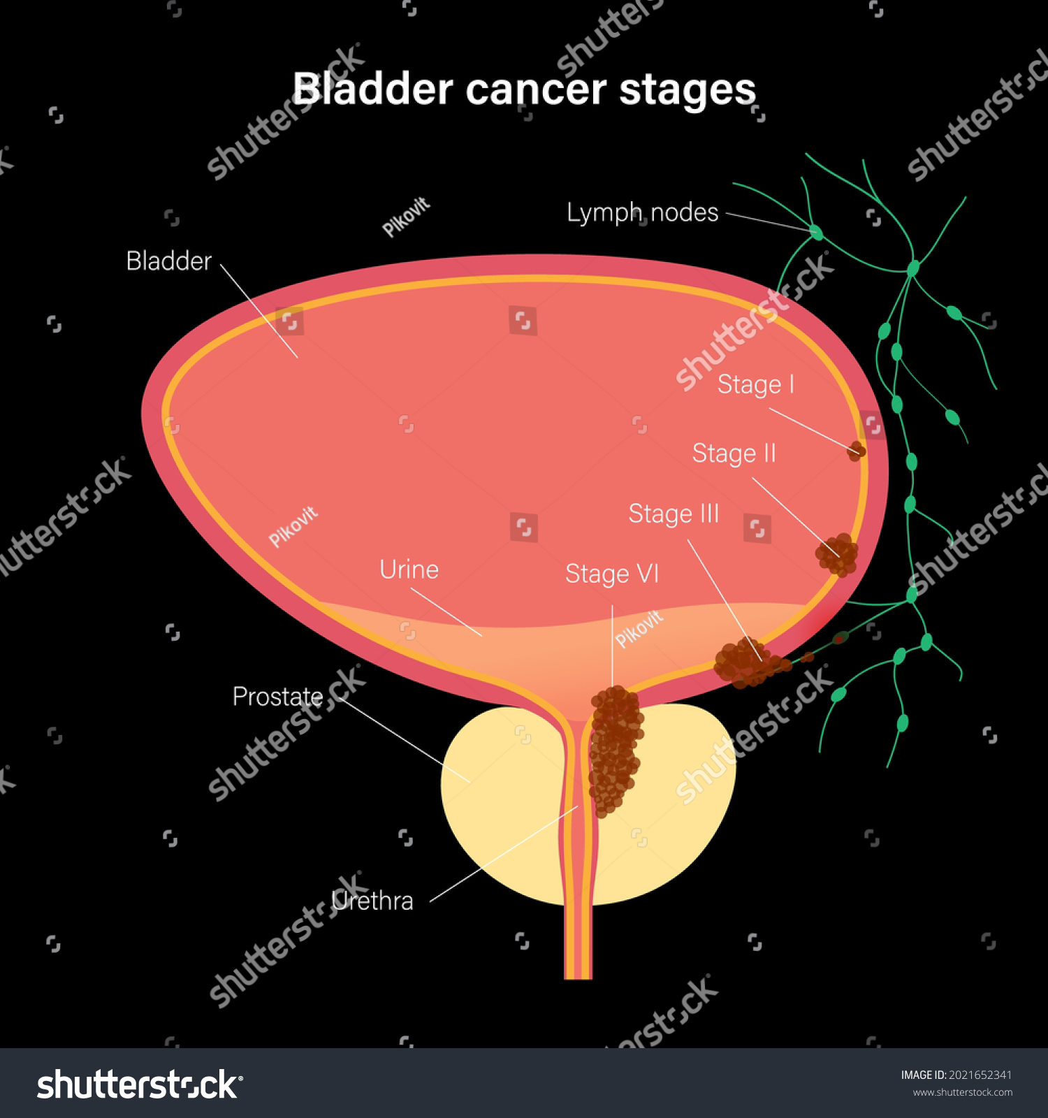 Bladder Cancer Stages Anatomical Poster Bladder Stock Vector (Royalty ...