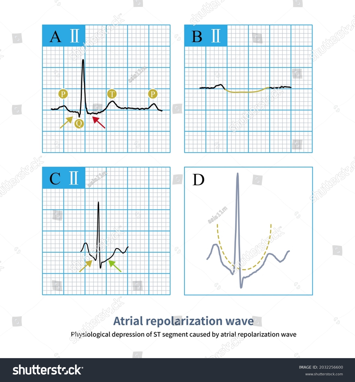 Atrial Repolarization Wave Can Cause St Stock Illustration 2032256600 