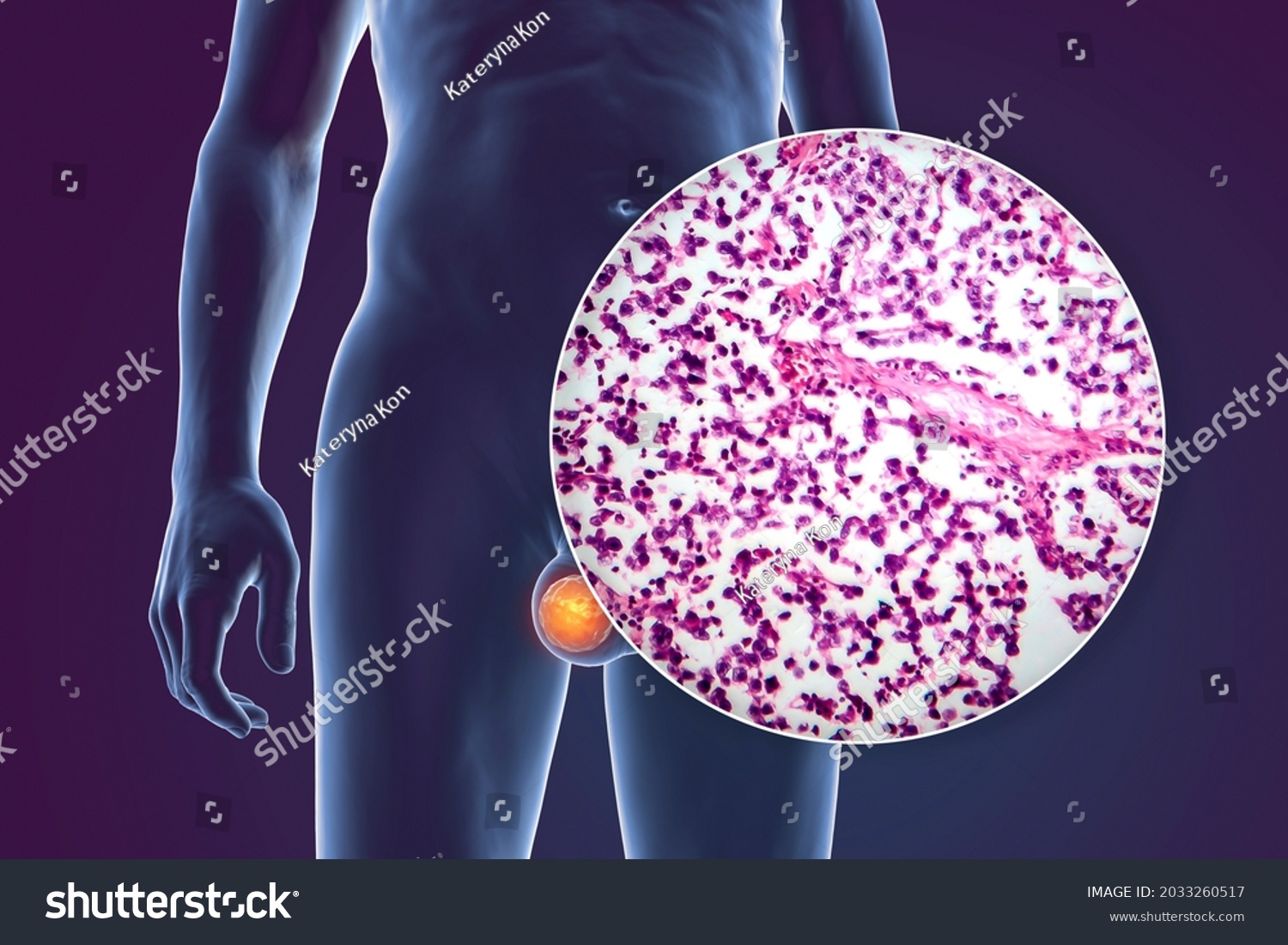 Testicular Cancer Testicular Seminoma Medical 3d Stock Illustration