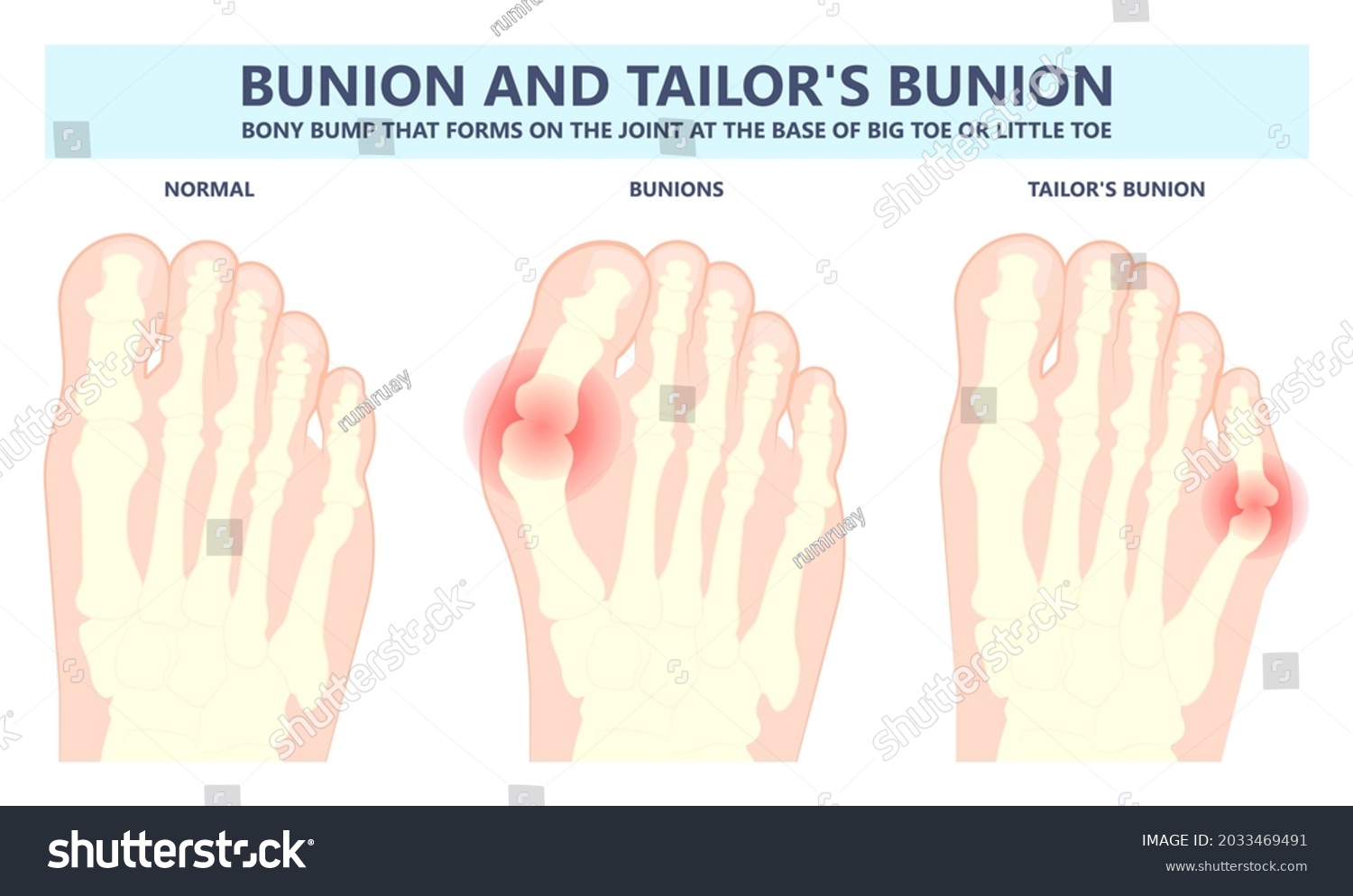 Bony Bump Joint Big Toe Bone Stock Vector (Royalty Free) 2033469491 ...