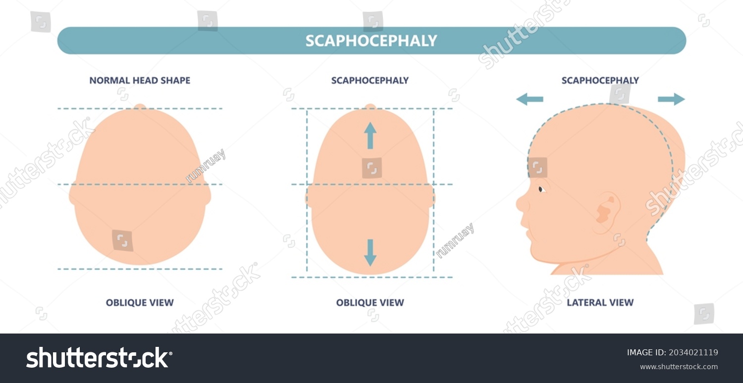 Craniosynostosis Helmet Pillow Flat Head Autism Stock Vector (Royalty ...