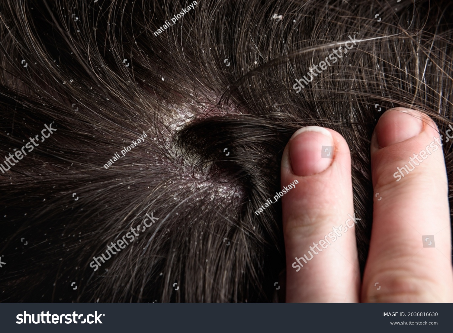 Dandruff Hair Flaky Scalp Seborrhea Stock Photo 2036816630 | Shutterstock