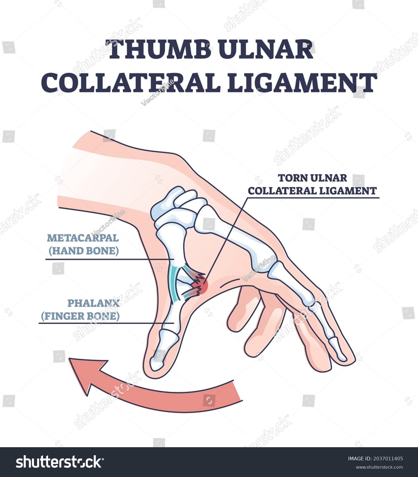 разрыв локтевой коллатеральной связки большого пальца. разрыв связки большого пальца руки. повреждения первый пястно фаланговый сустав. профилактика разрыва связок. вывих дистальной фаланги пальца.