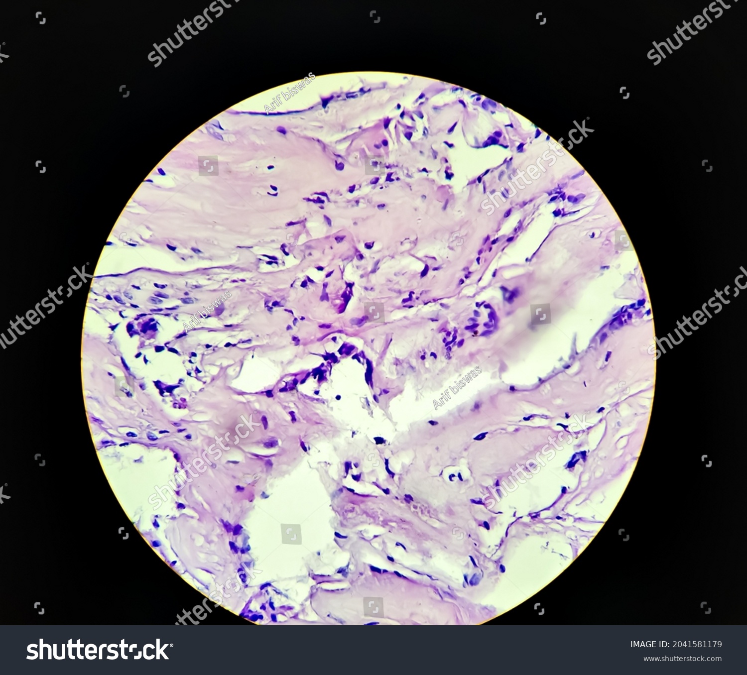 Lobular Capillary Hemangioma Light Micrograph Photo Foto Stock ...