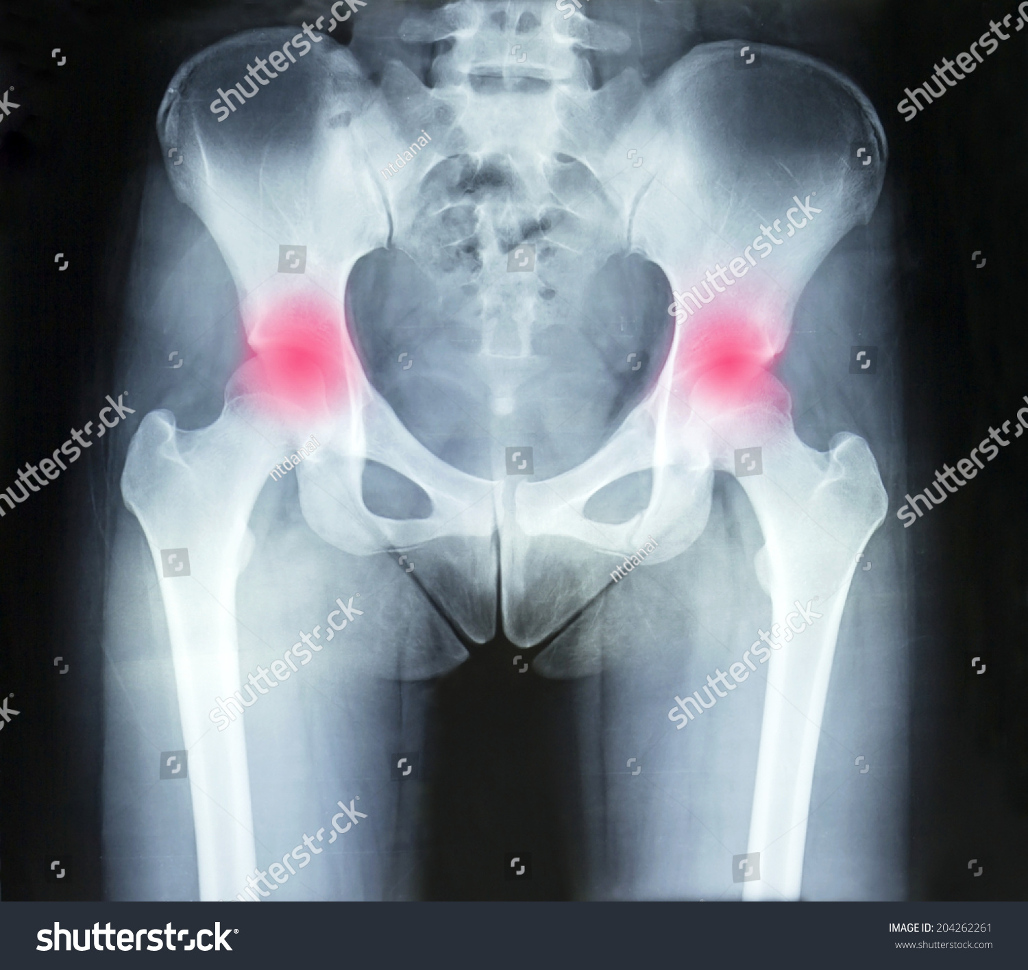 Рентгеновский снимок таза женщины